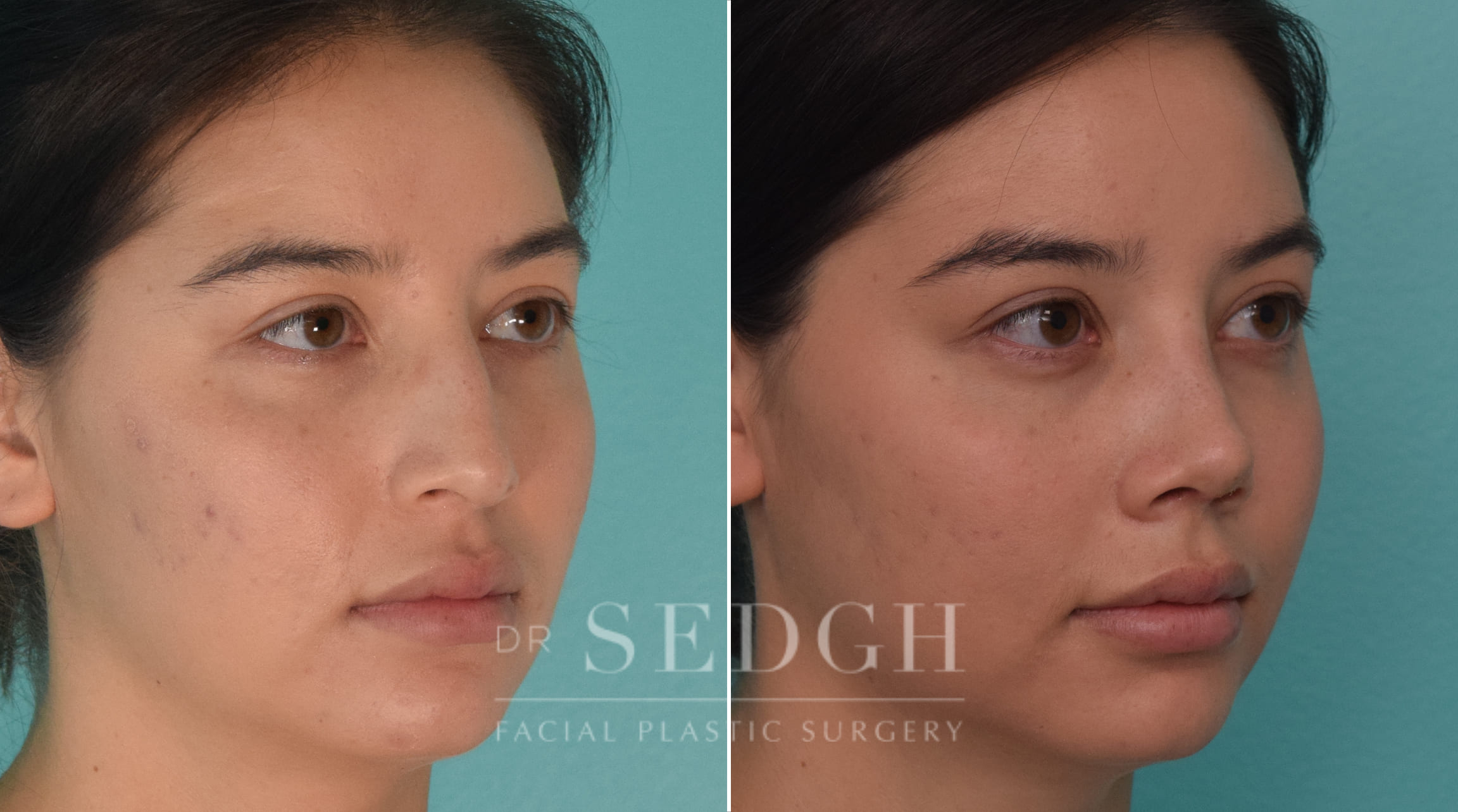 patient before and after rhinoplasty procedure