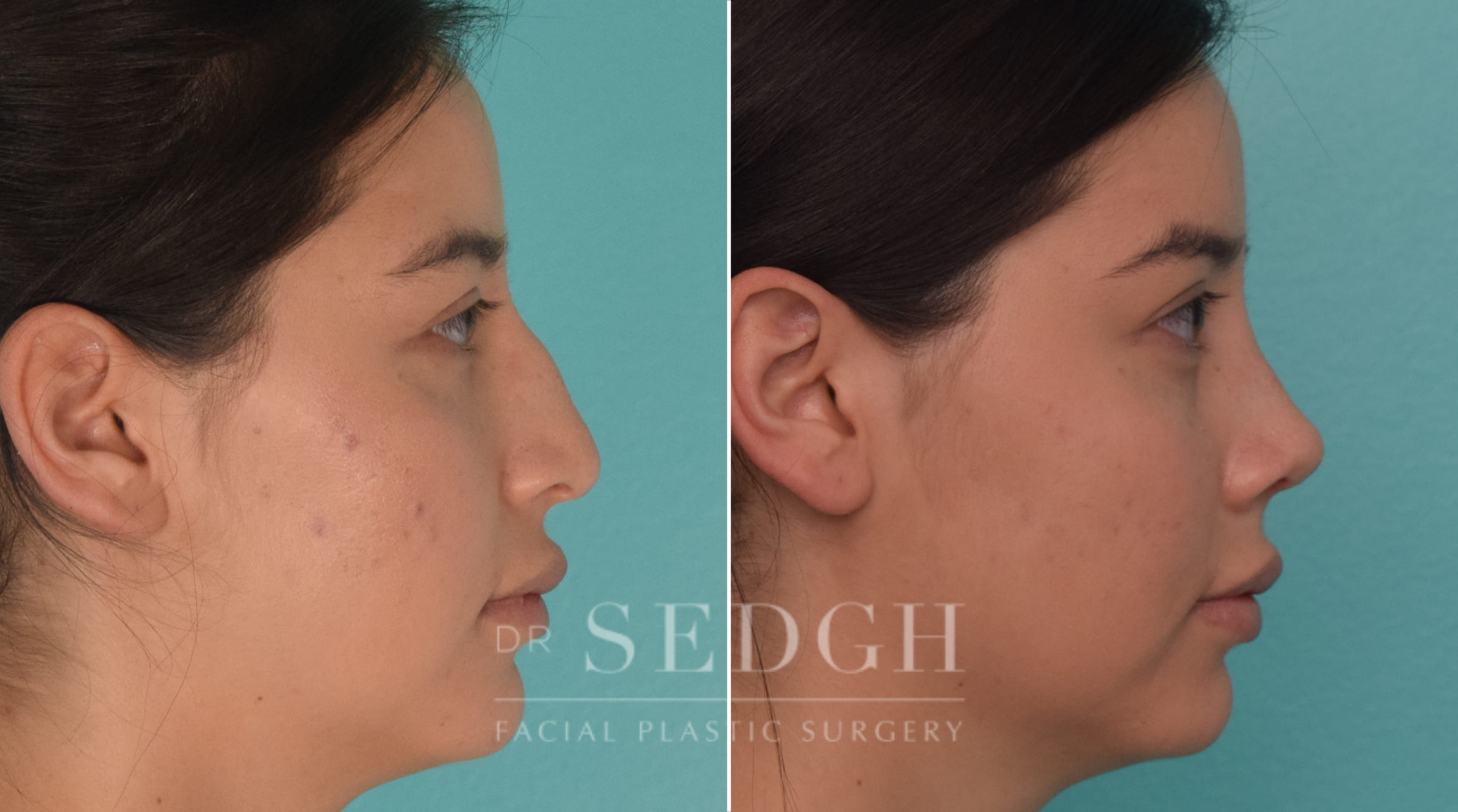 patient before and after rhinoplasty procedure