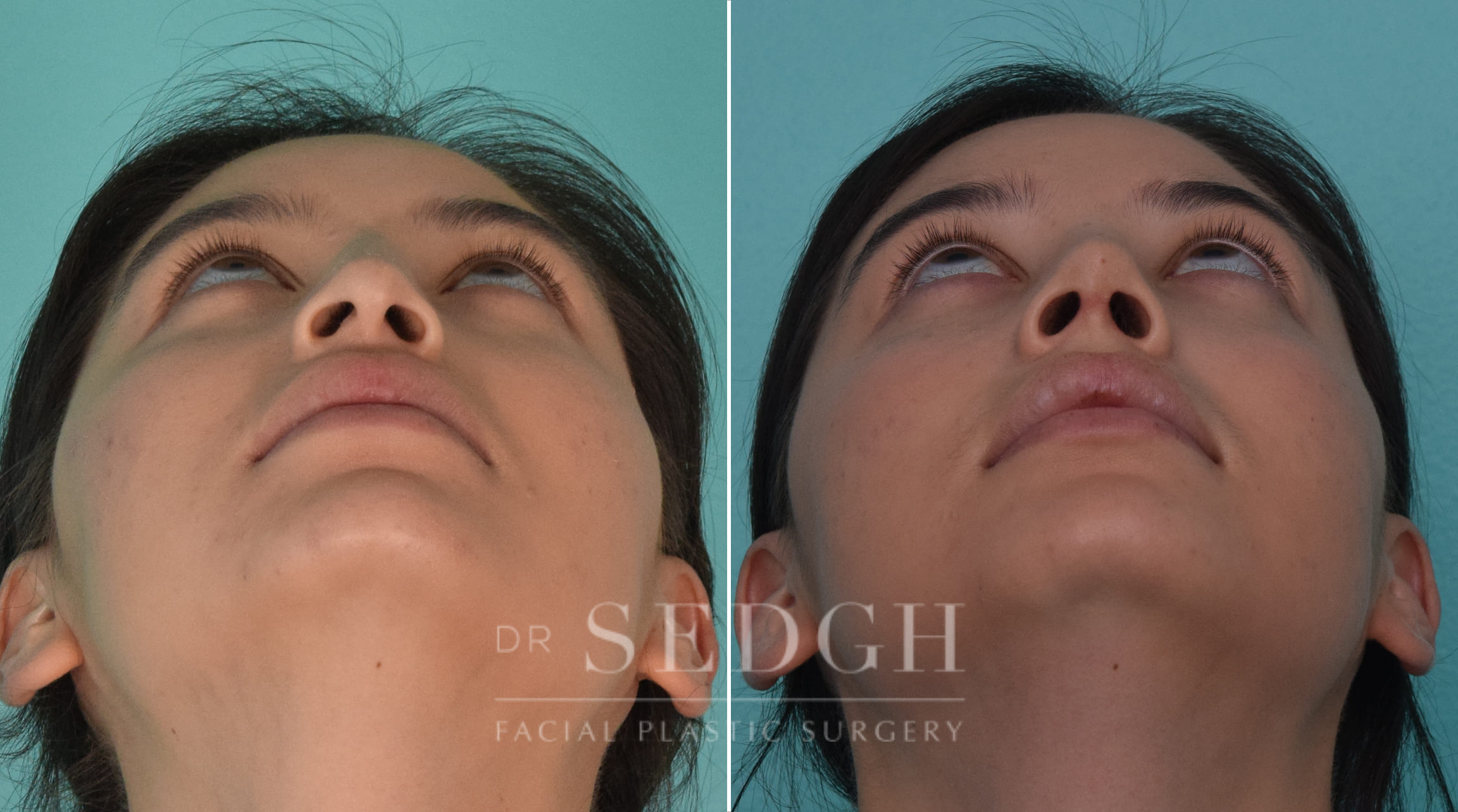 patient before and after rhinoplasty procedure