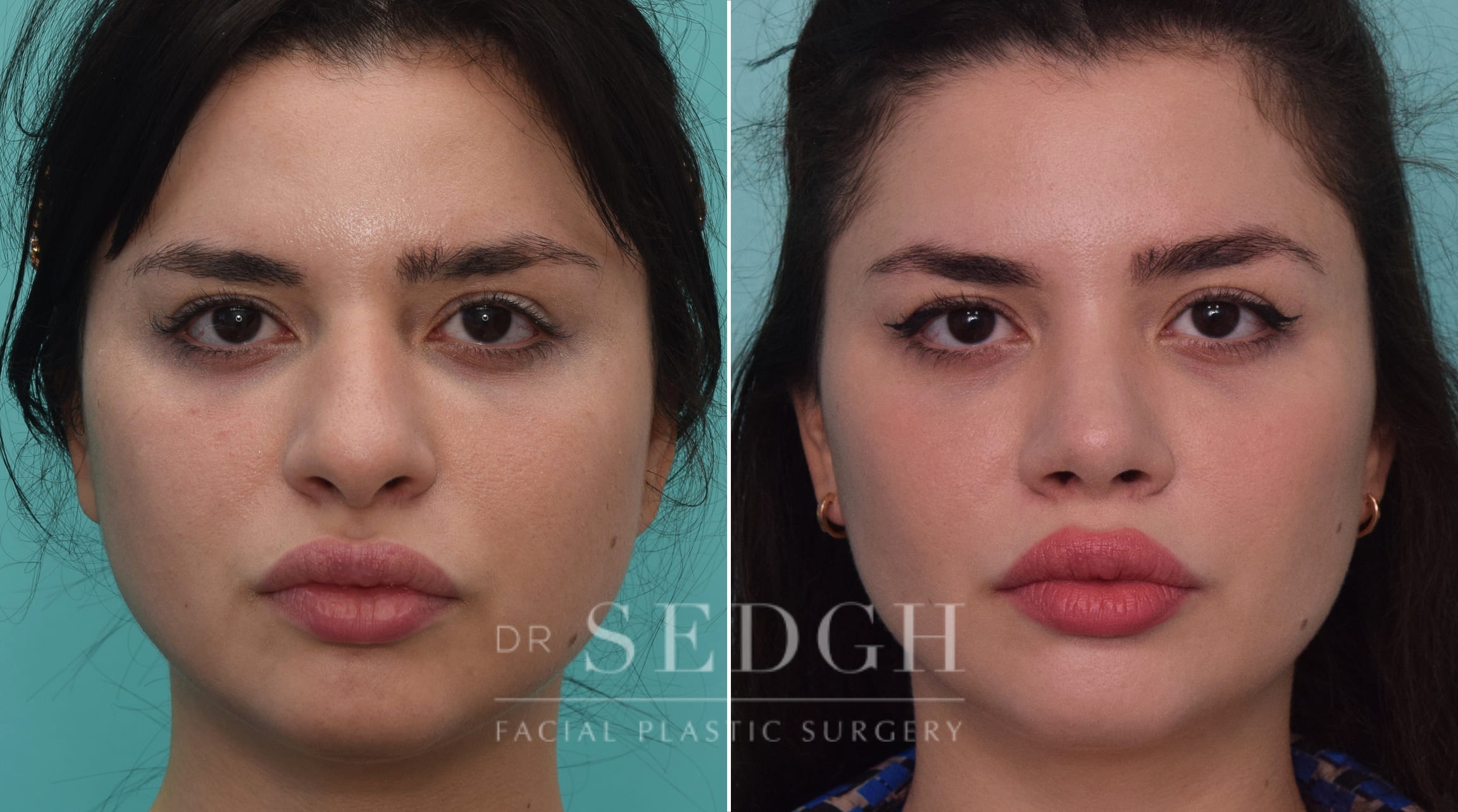 Rhinoplasty Before and After | Sedgh