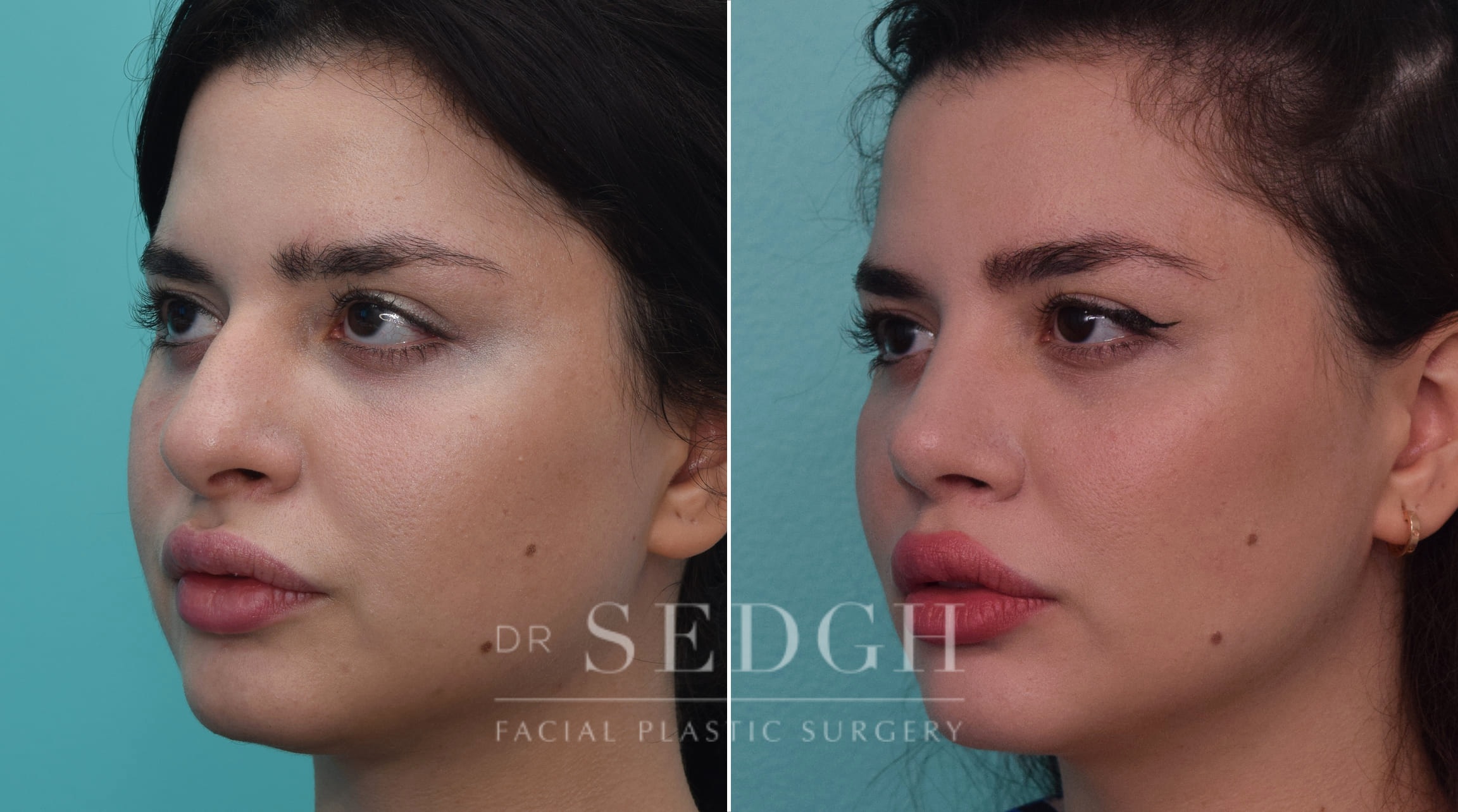 Rhinoplasty Before and After | Sedgh