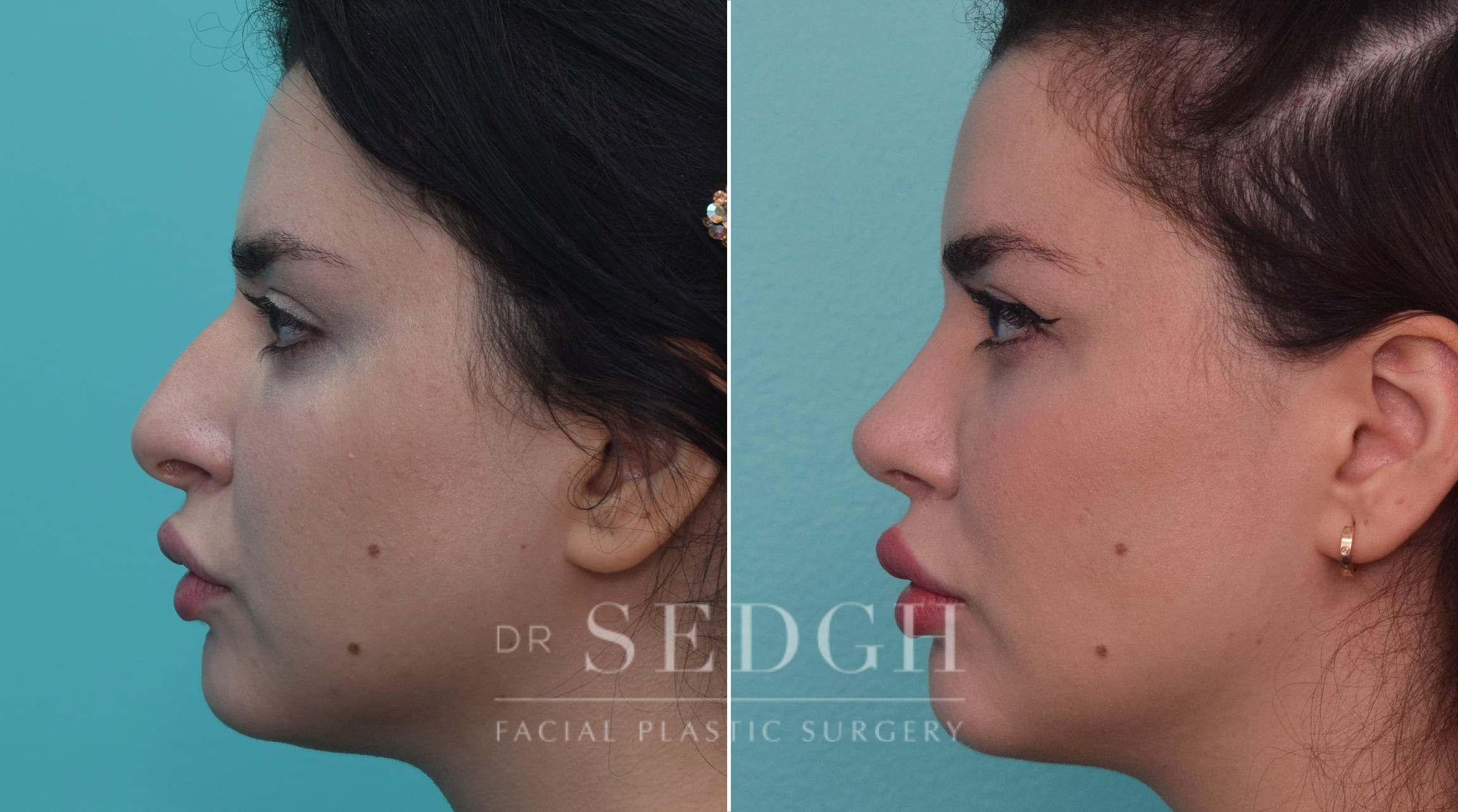 Rhinoplasty Before and After | Sedgh