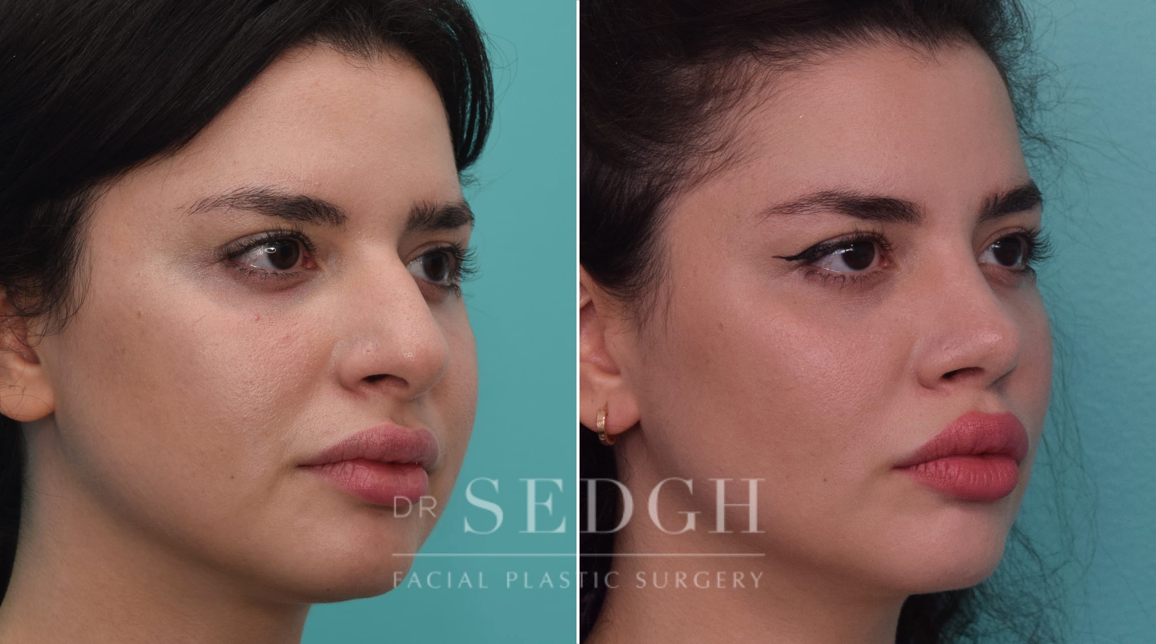 Rhinoplasty Before and After | Sedgh