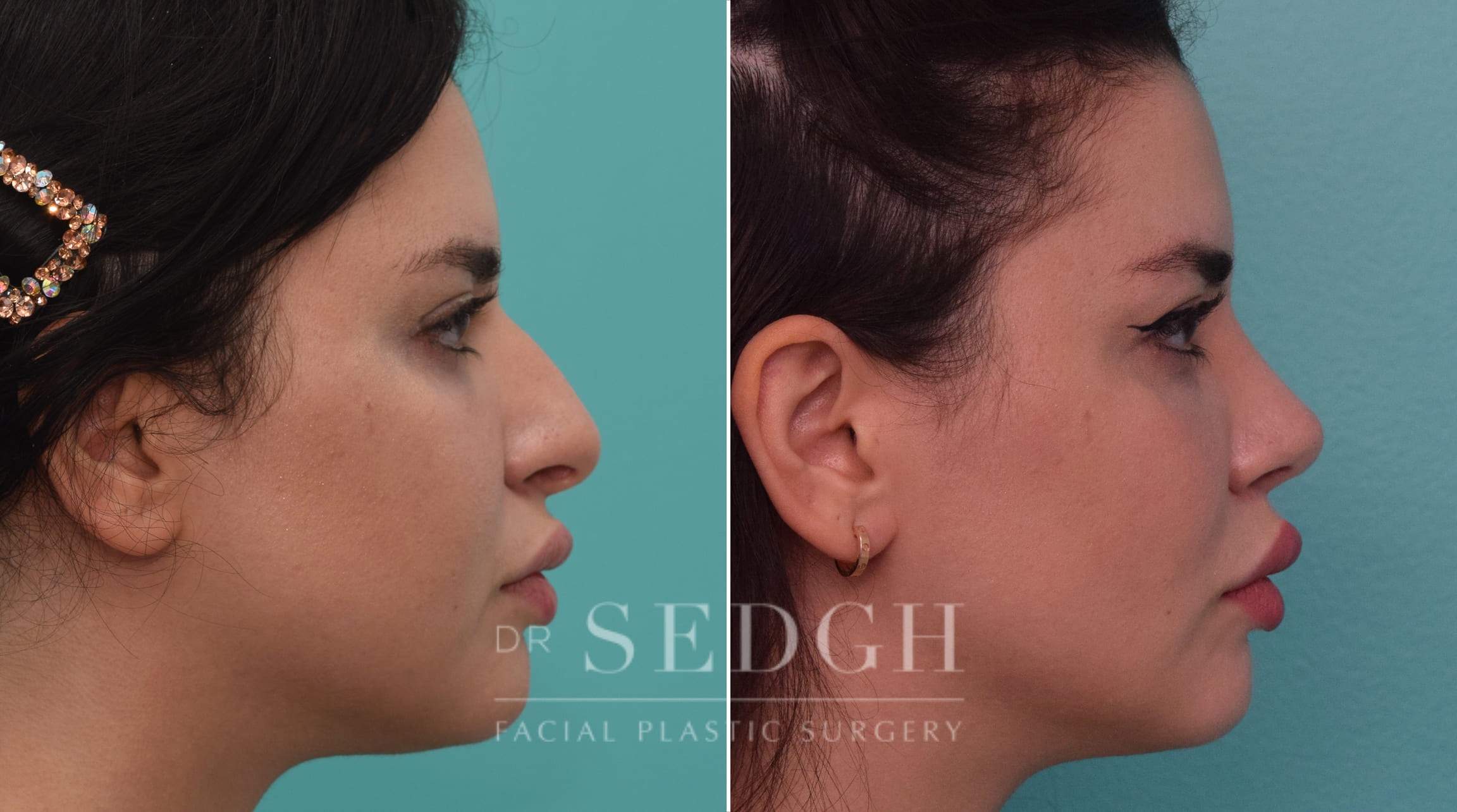 Rhinoplasty Before and After | Sedgh