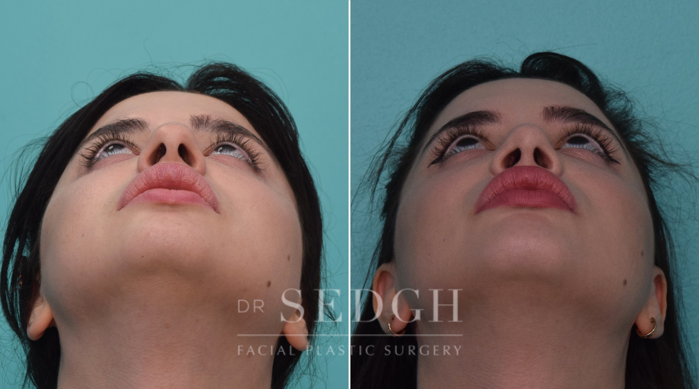 Rhinoplasty Before and After | Sedgh