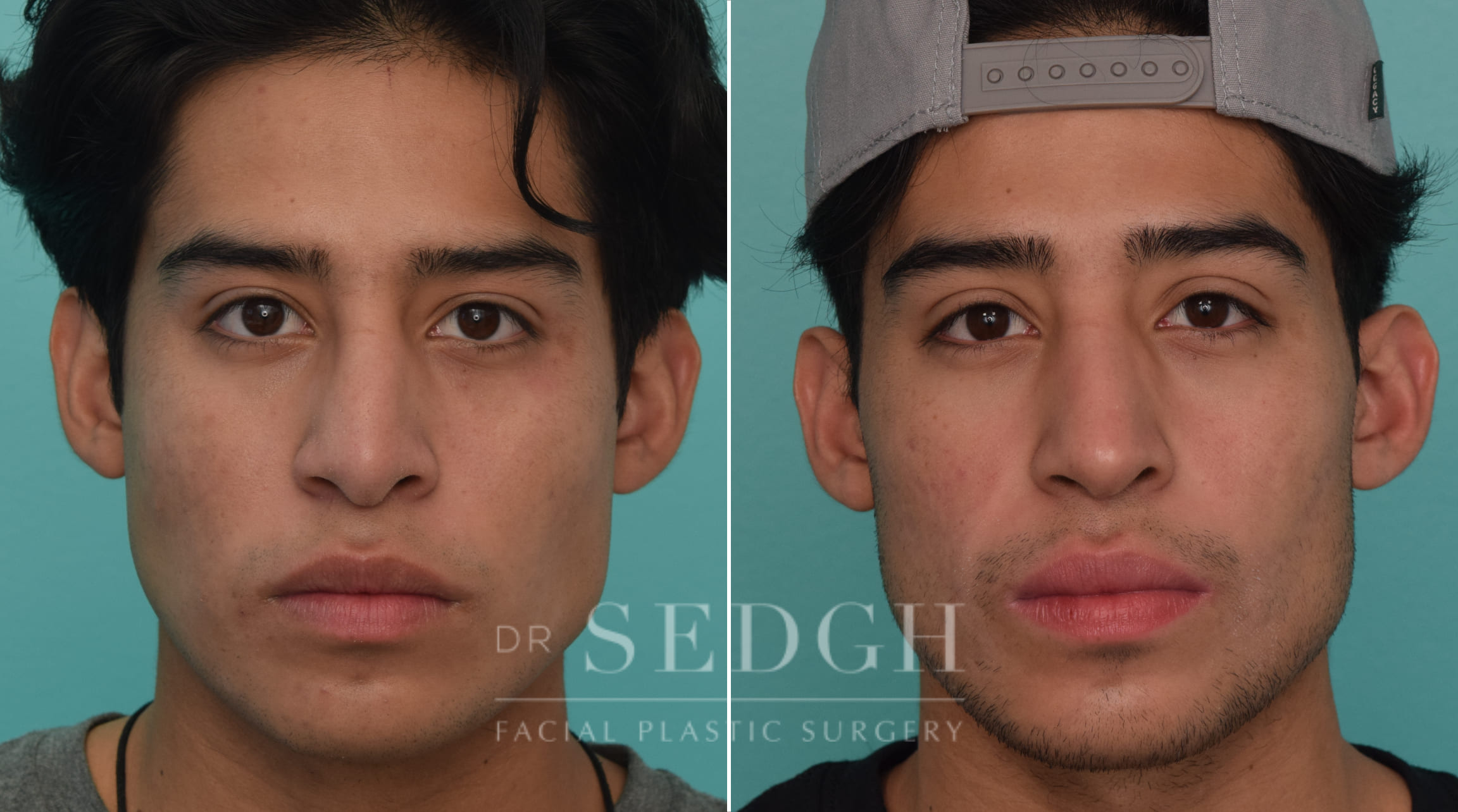 patient before and after revision rhinoplasty procedure