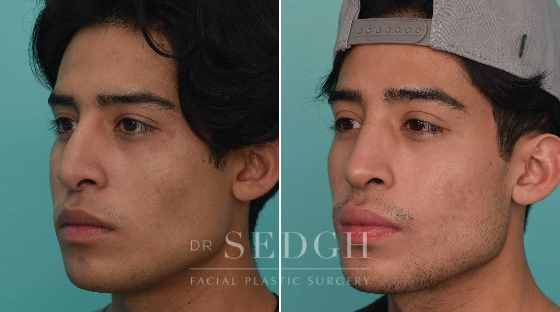 patient before and after revision rhinoplasty procedure