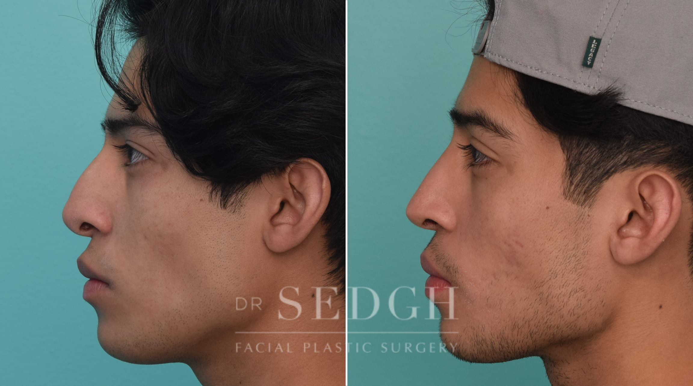 patient before and after revision rhinoplasty procedure