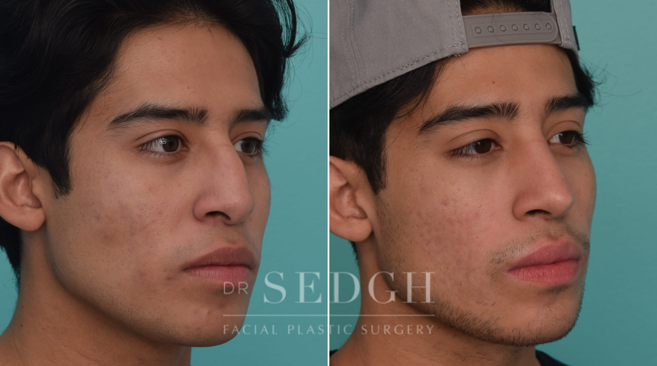 patient before and after revision rhinoplasty procedure