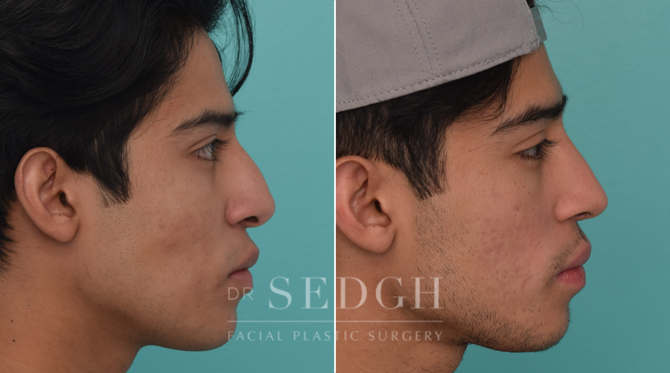 patient before and after revision rhinoplasty procedure