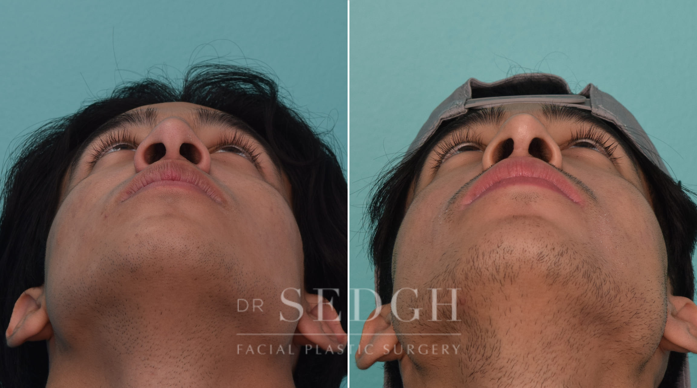 patient before and after revision rhinoplasty procedure