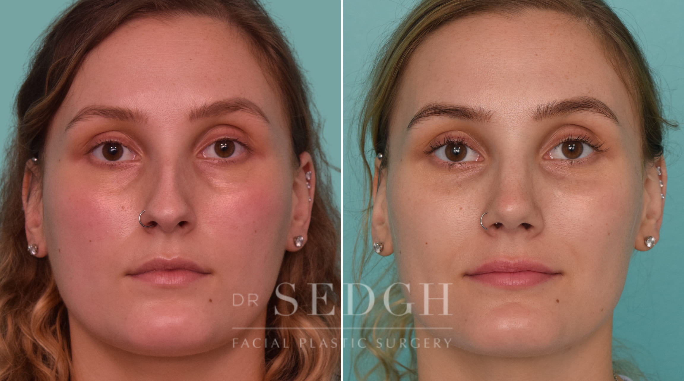 female patient before and after rhinoplasty procedure