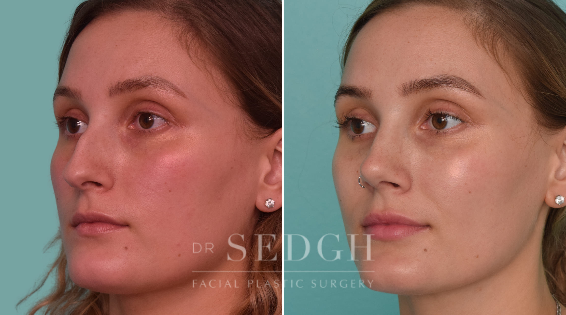 female patient before and after rhinoplasty procedure