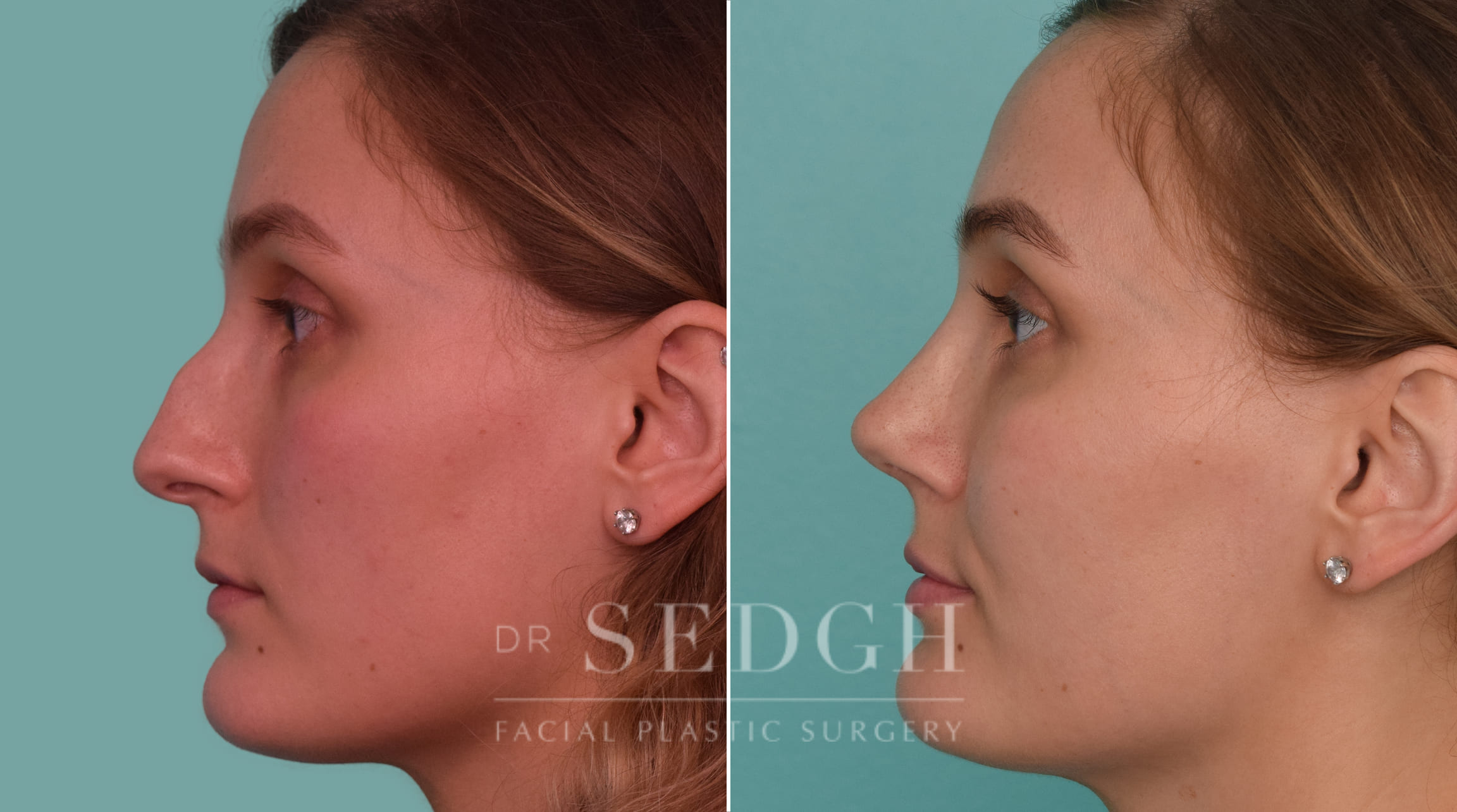 female patient before and after rhinoplasty procedure