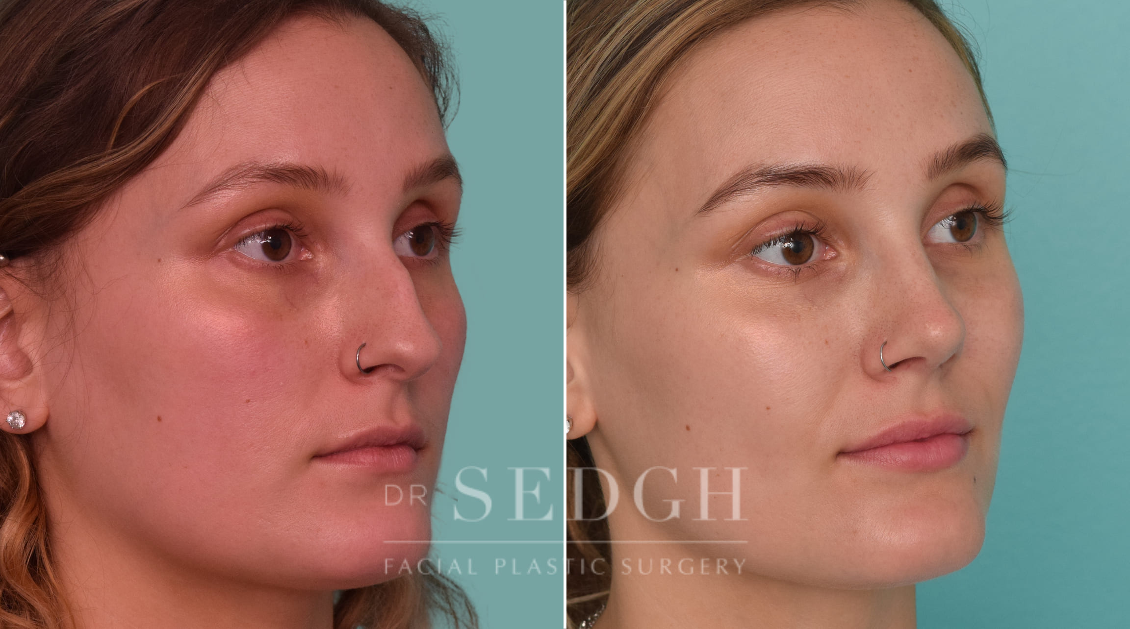 female patient before and after rhinoplasty procedure