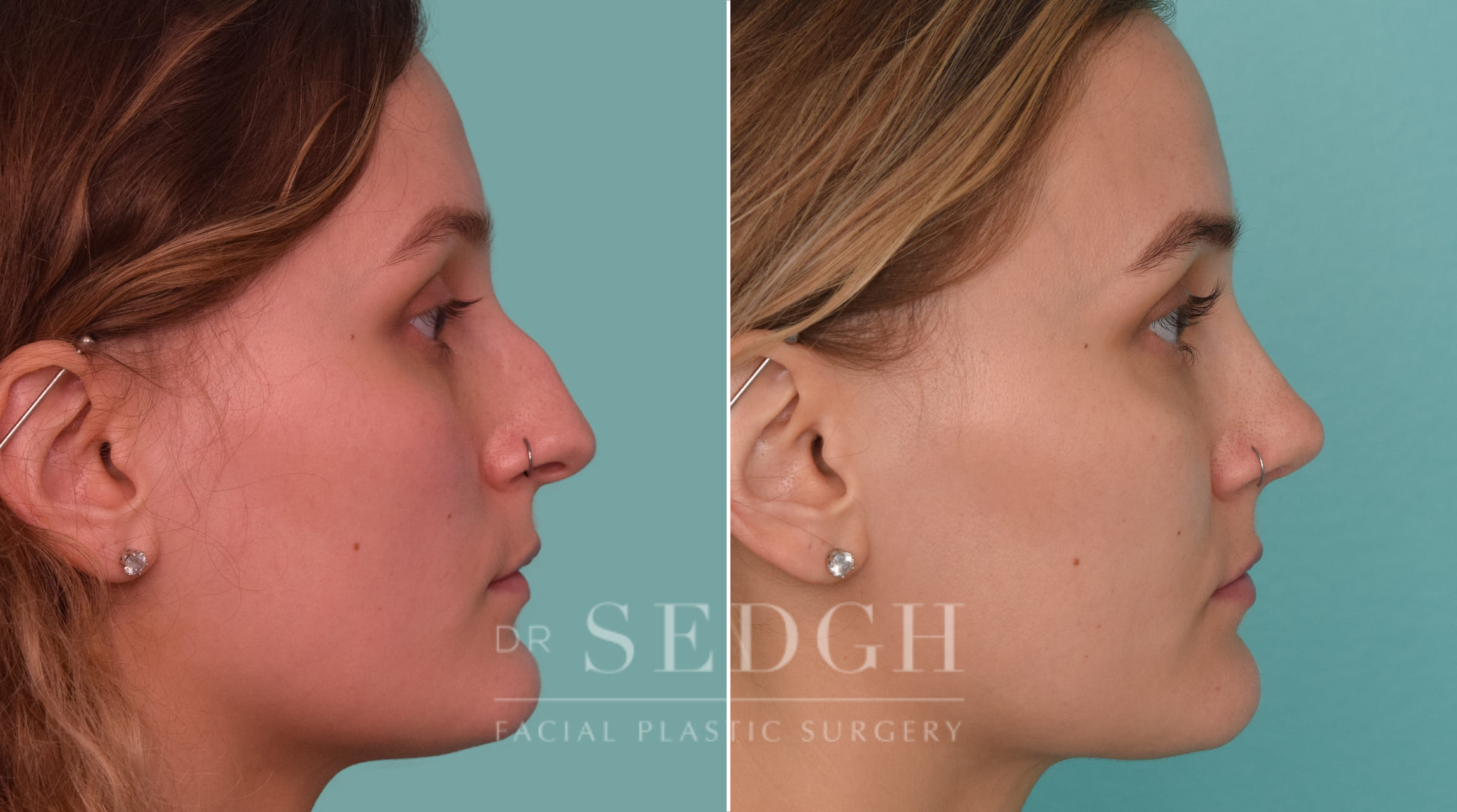 female patient before and after rhinoplasty procedure