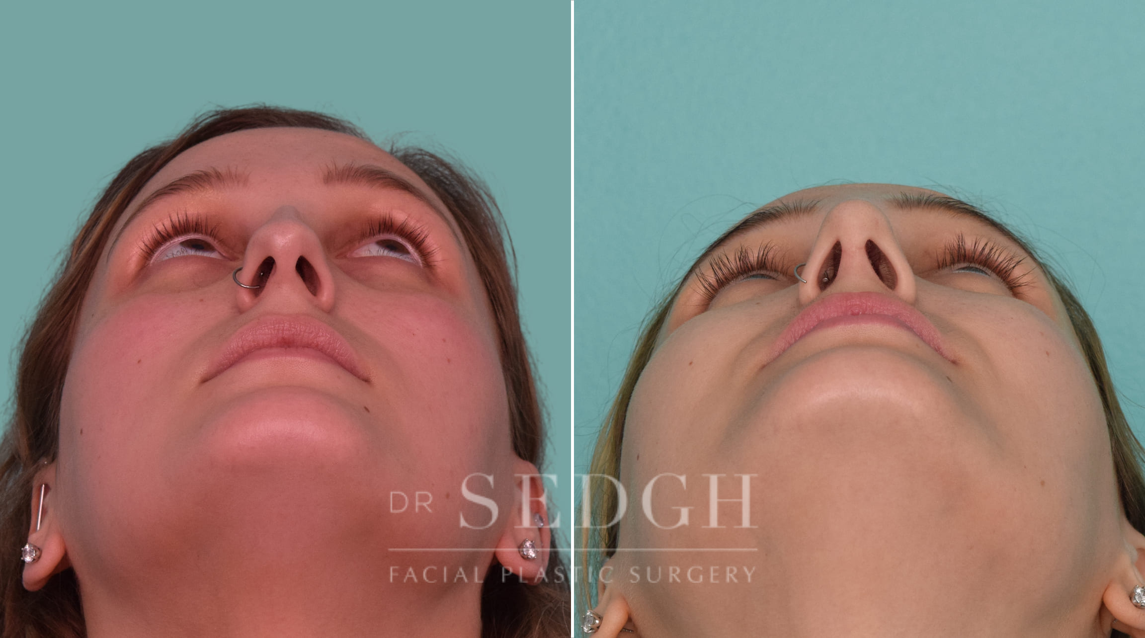 female patient before and after rhinoplasty procedure