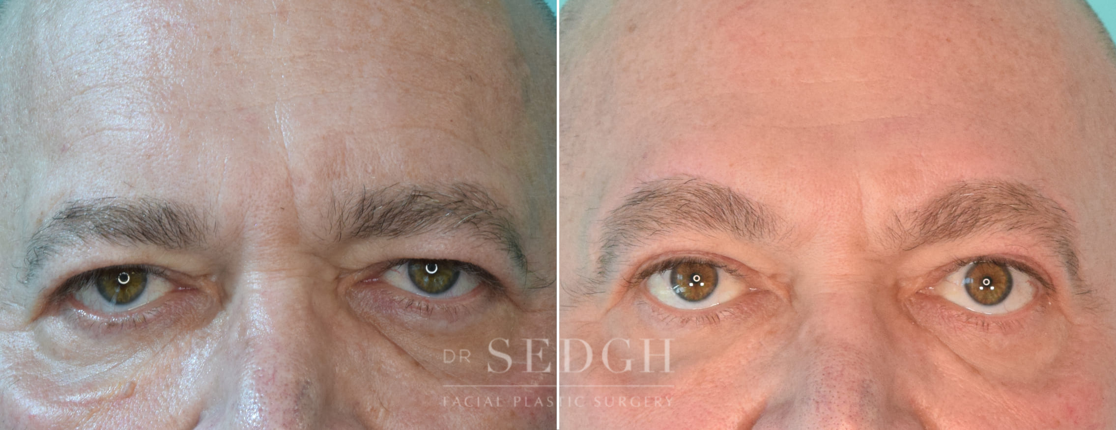 male patient before and after brow lift procedure | Sedgh