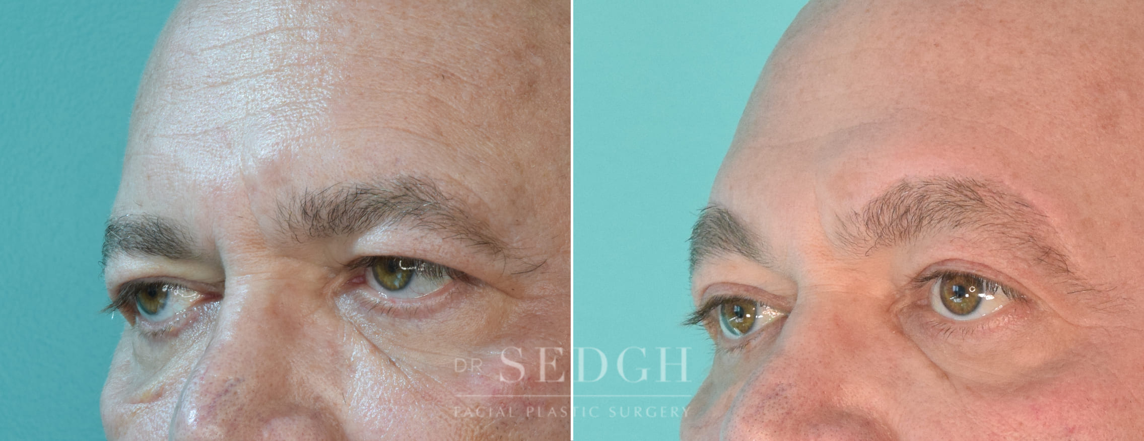 male patient before and after brow lift procedure | Sedgh