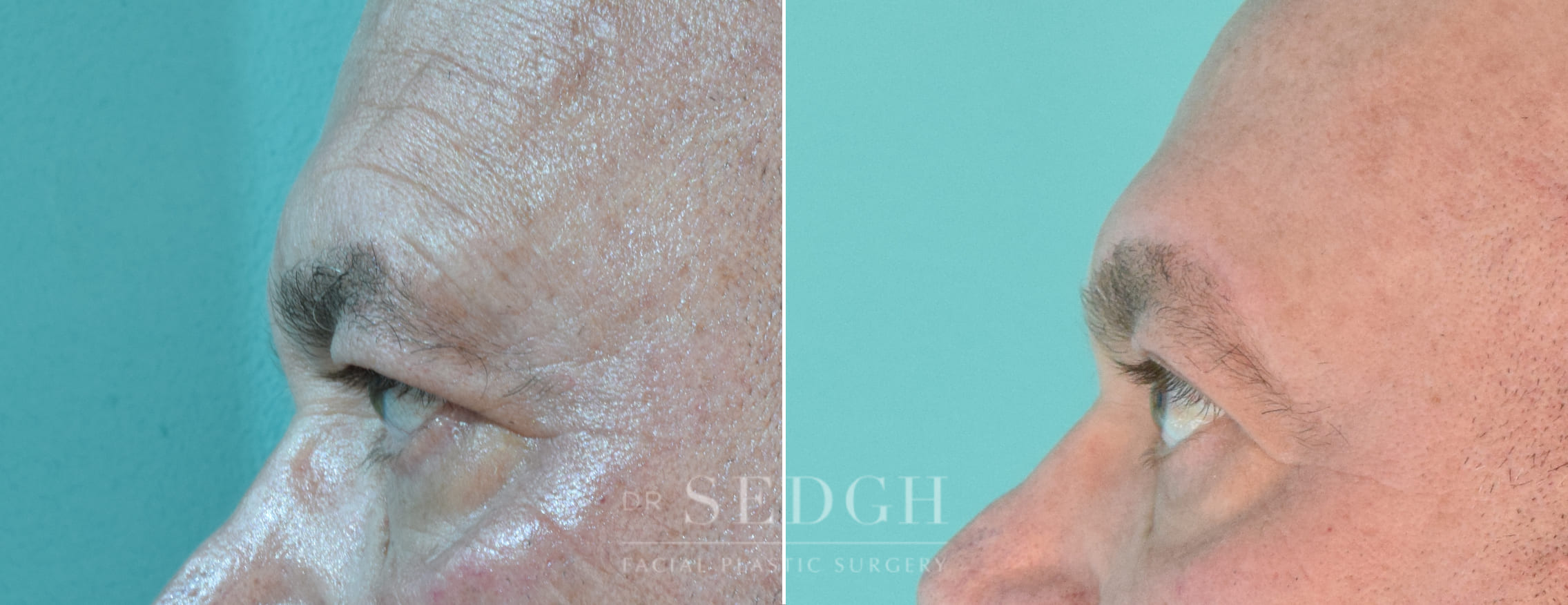 male patient before and after brow lift procedure | Sedgh