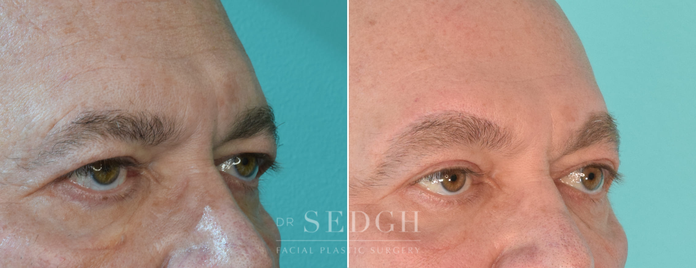 male patient before and after brow lift procedure | Sedgh