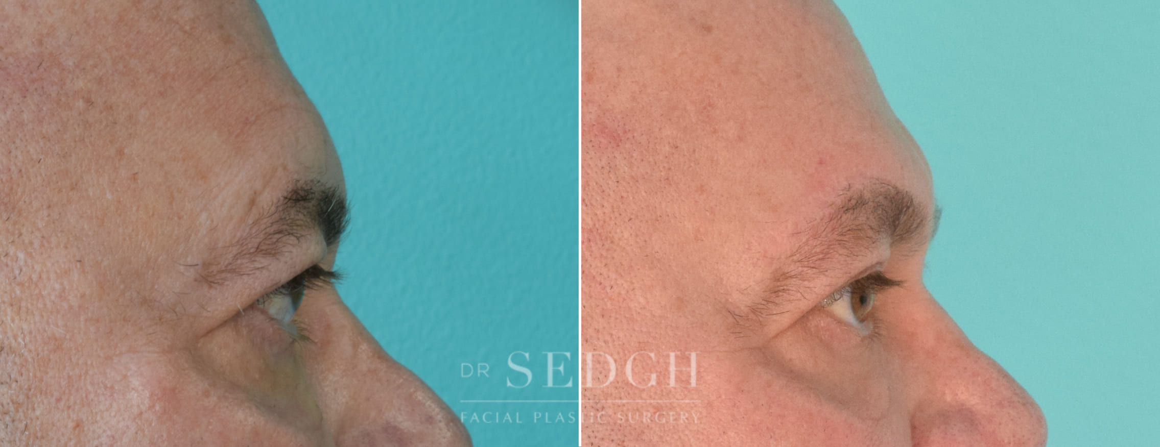 male patient before and after brow lift procedure | Sedgh