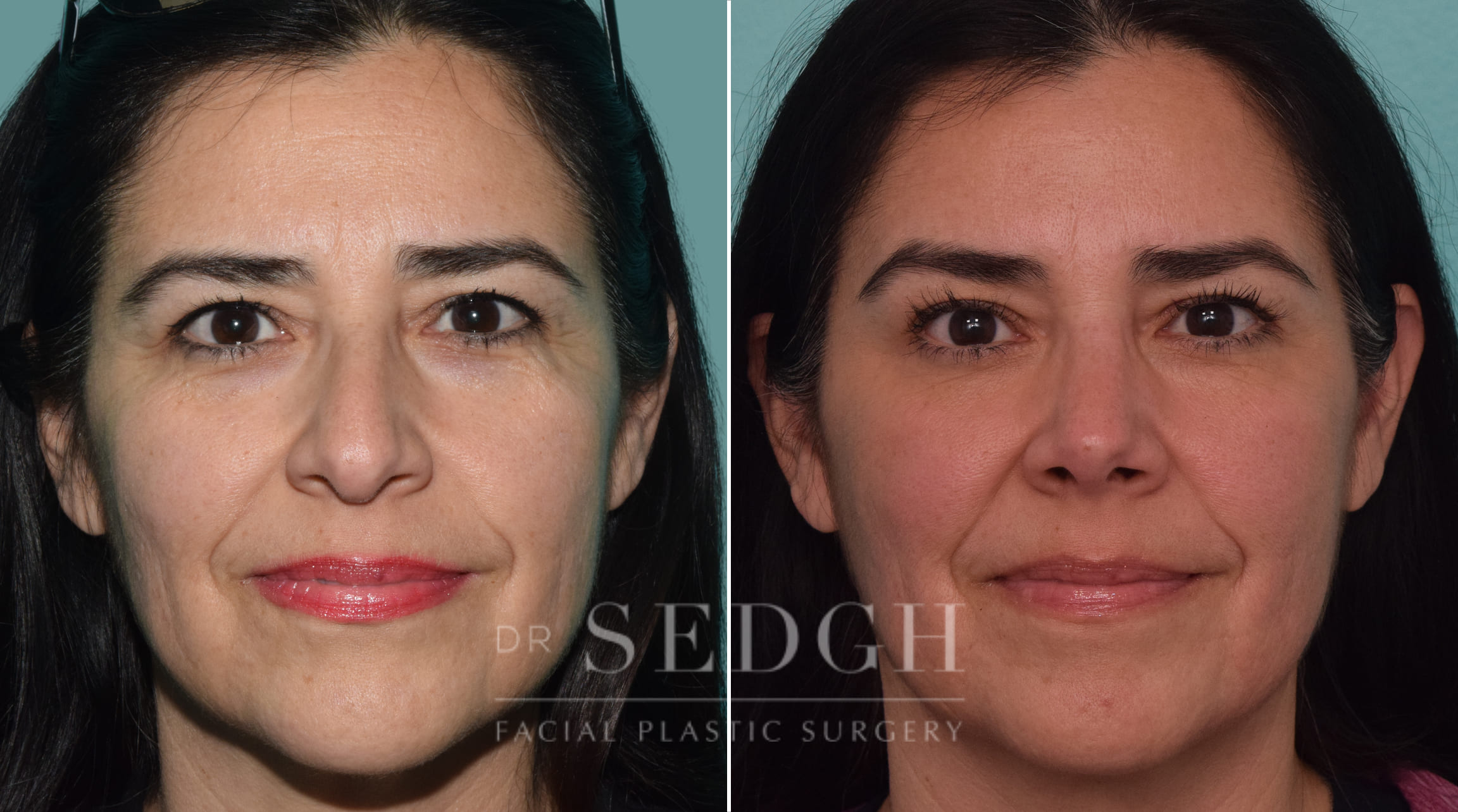 female patient before and after rhinoplasty procedure | Sedgh