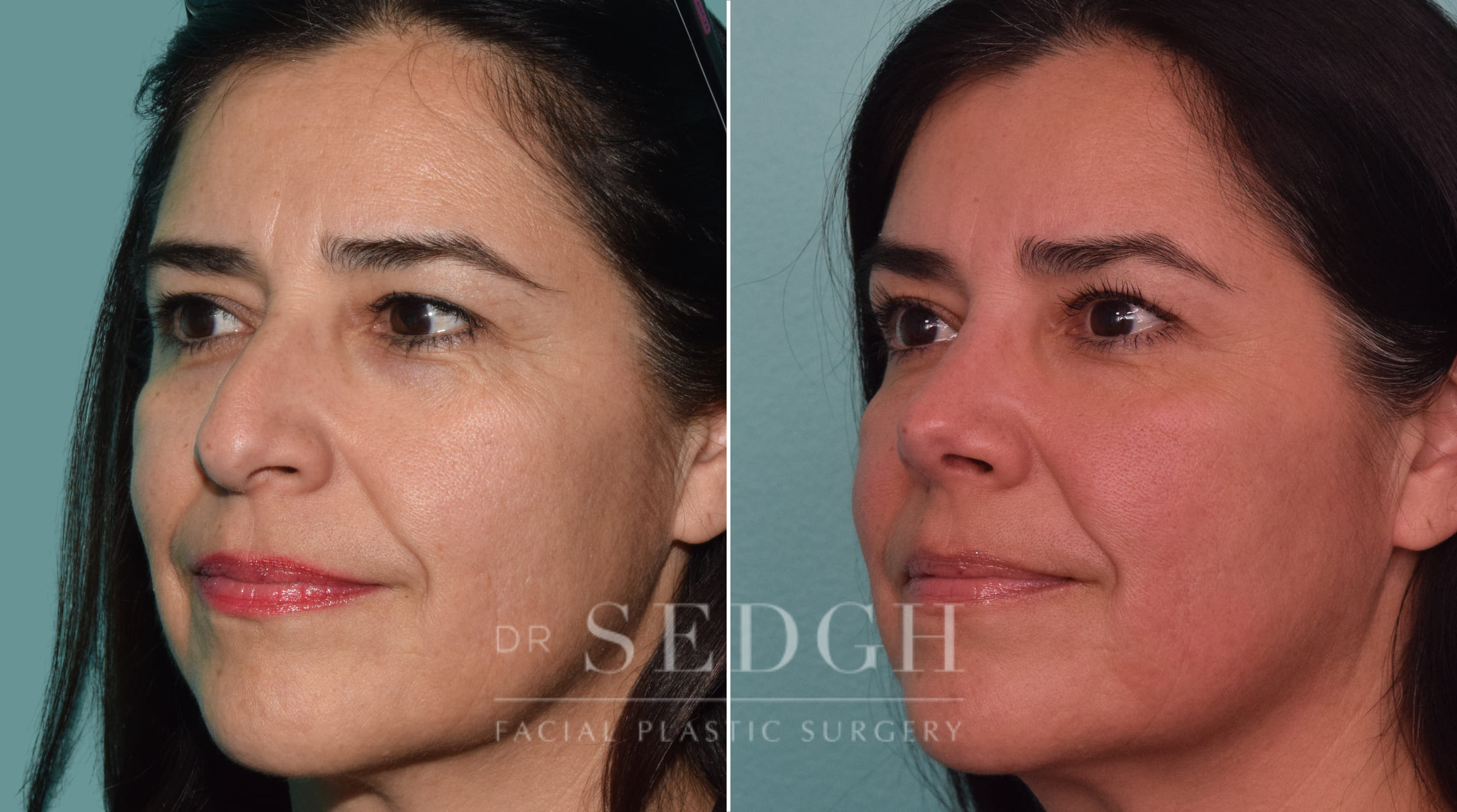 female patient before and after rhinoplasty procedure | Sedgh