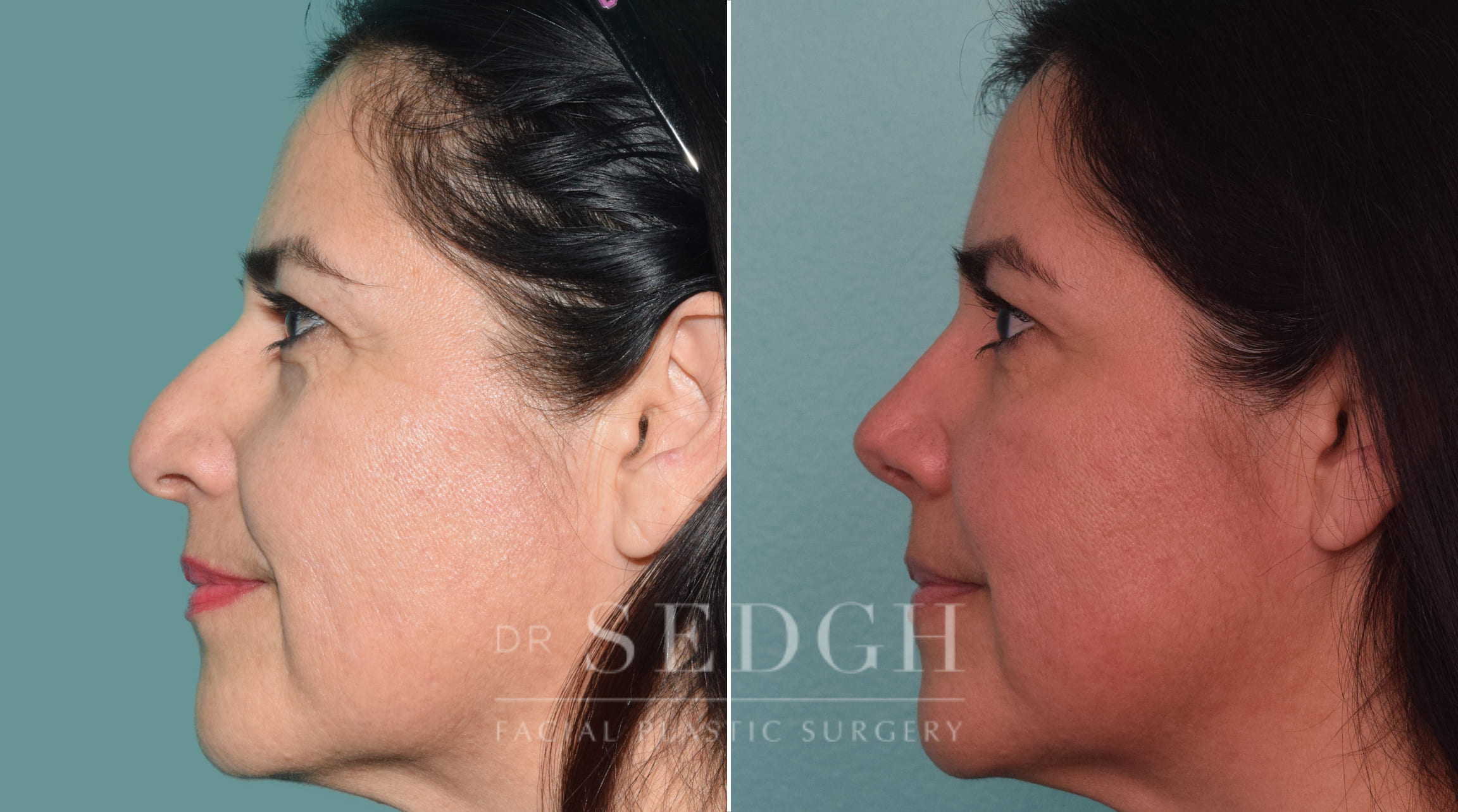 female patient before and after rhinoplasty procedure | Sedgh