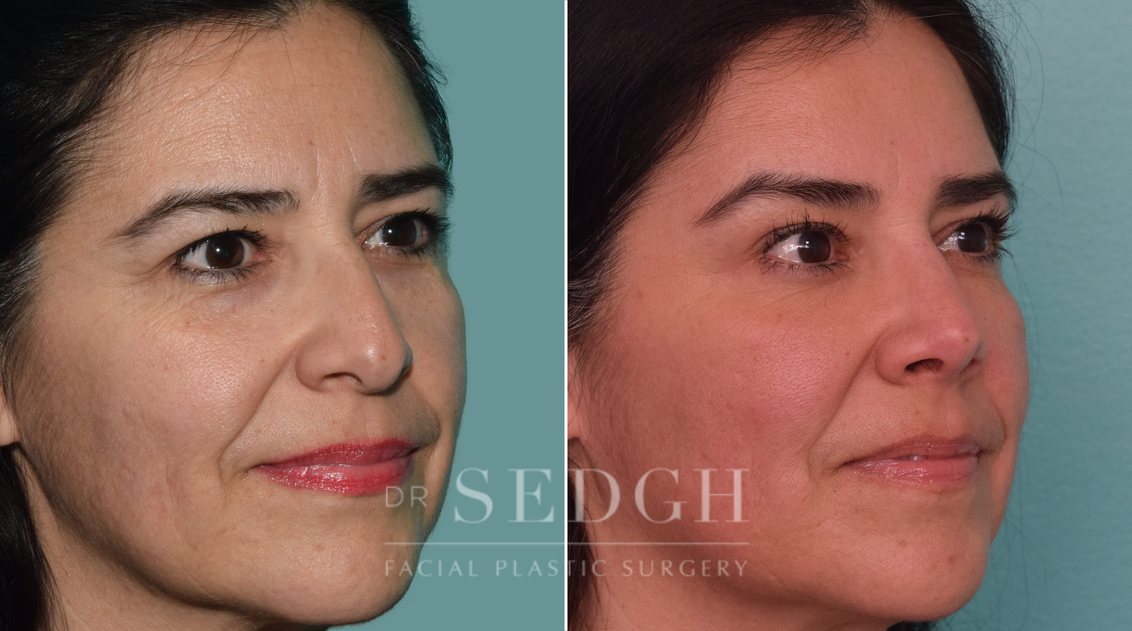 female patient before and after rhinoplasty procedure | Sedgh