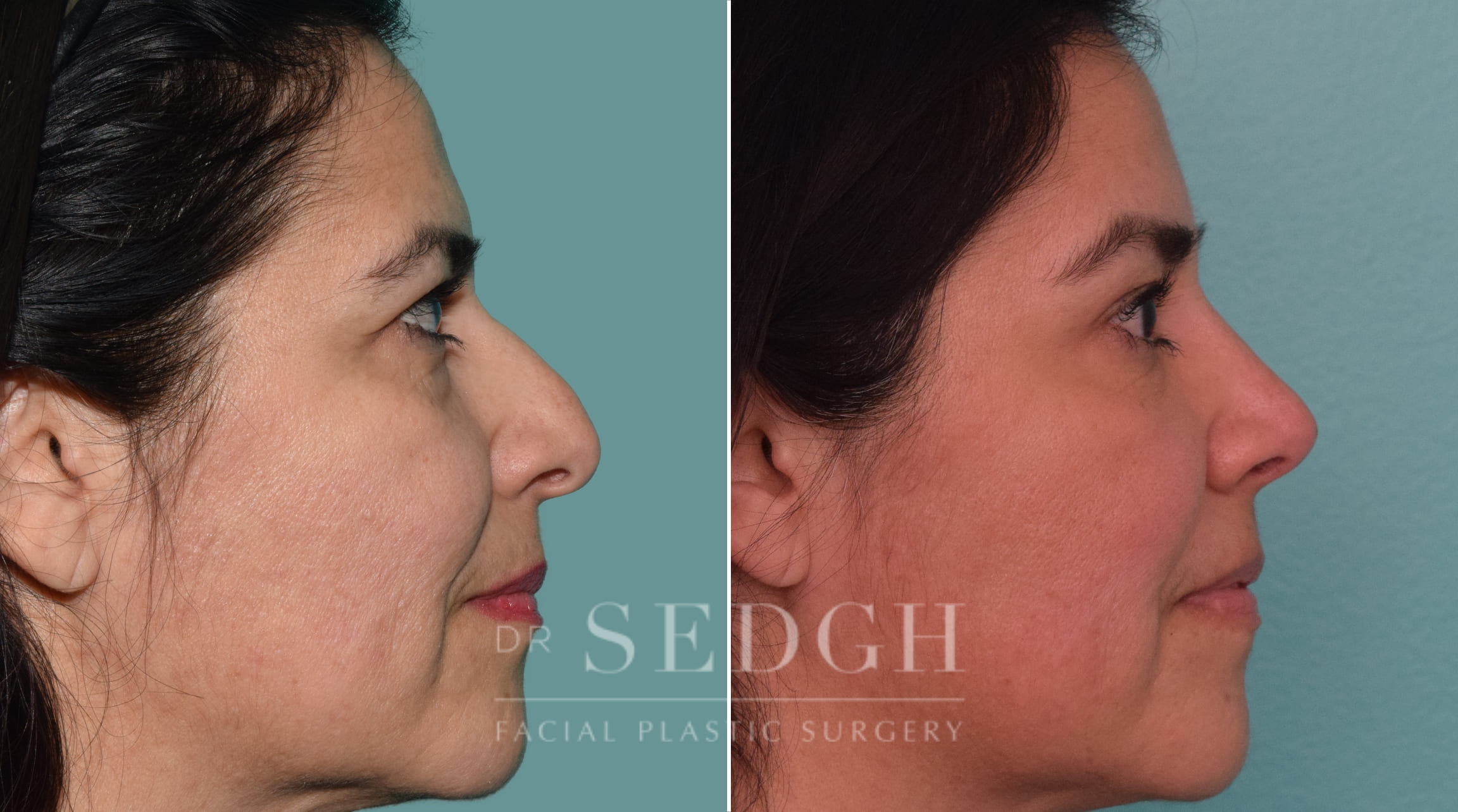 female patient before and after rhinoplasty procedure | Sedgh