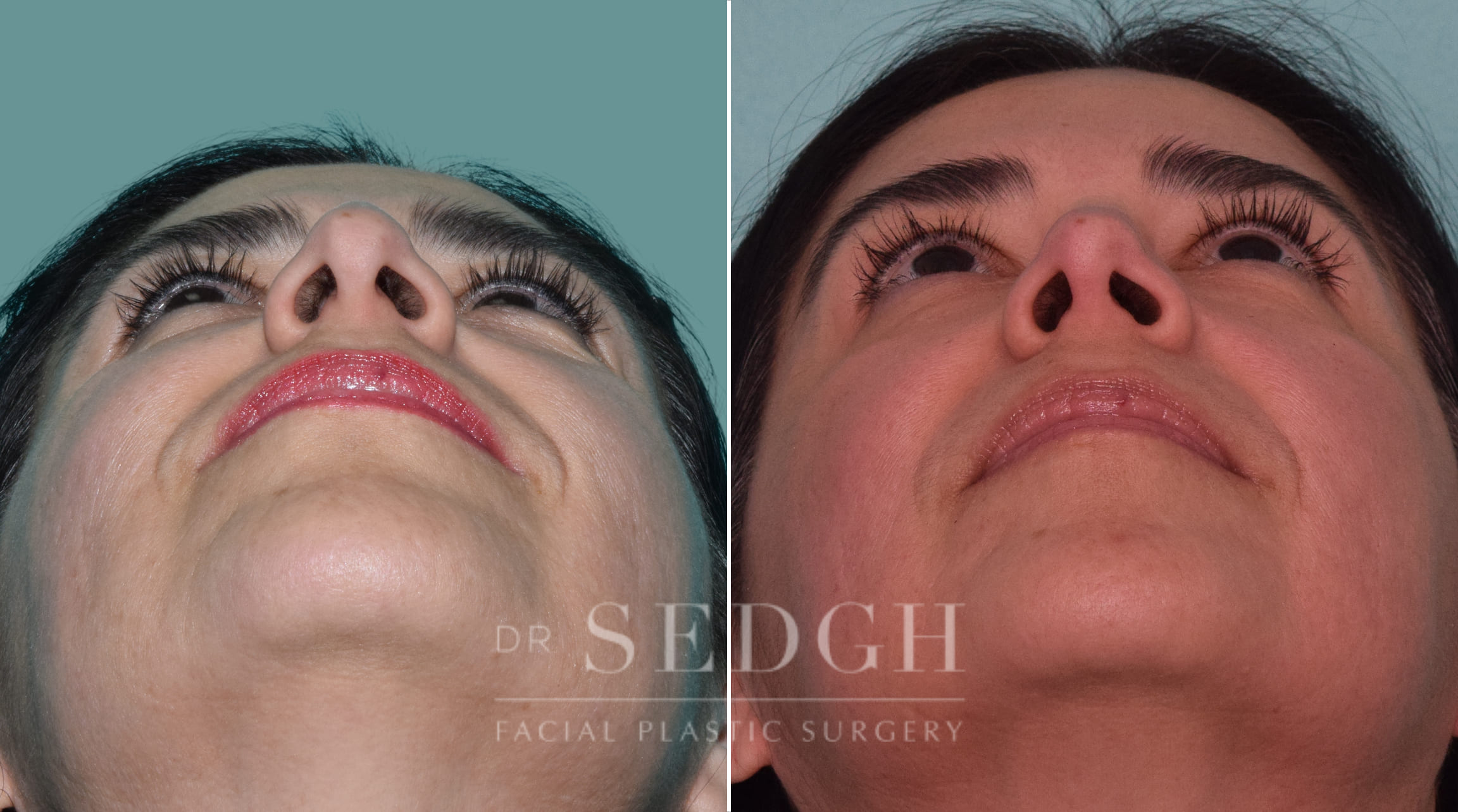 female patient before and after rhinoplasty procedure | Sedgh