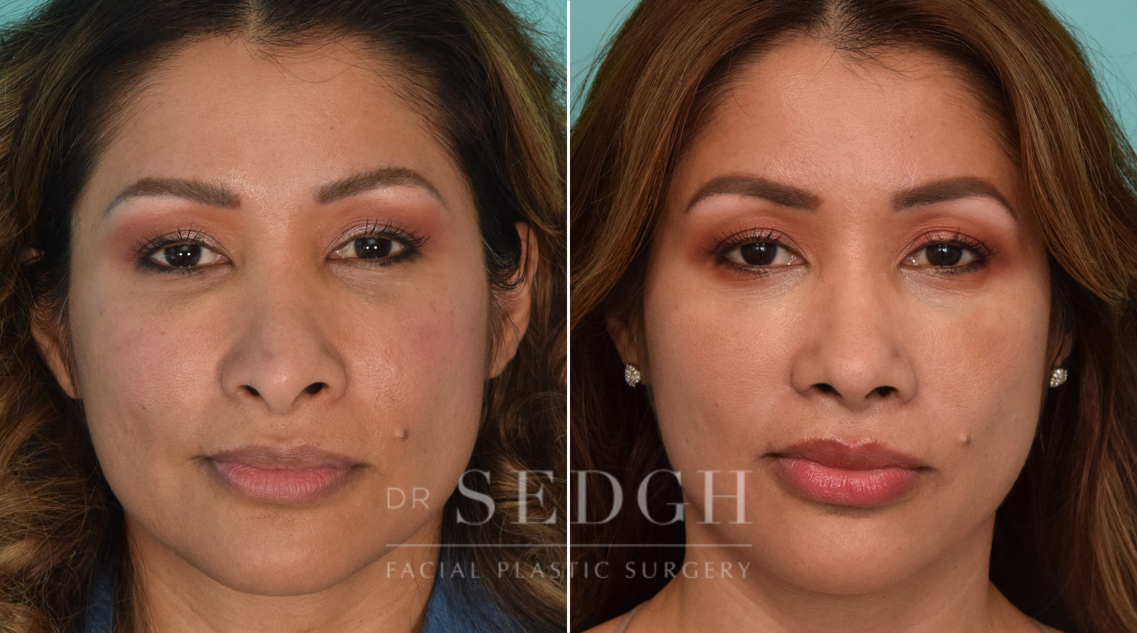 patient before and after revision rhinoplasty procedure