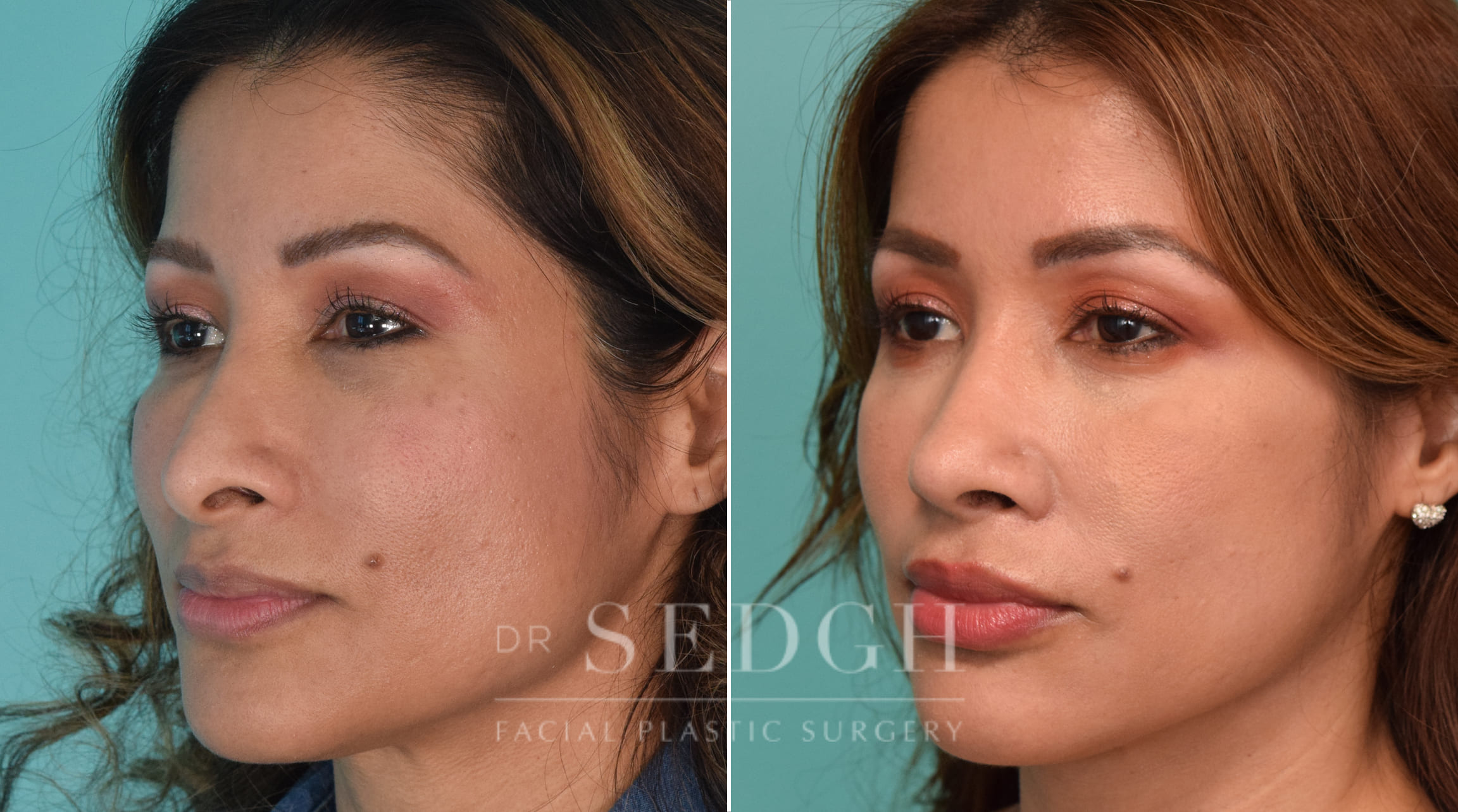 patient before and after revision rhinoplasty procedure