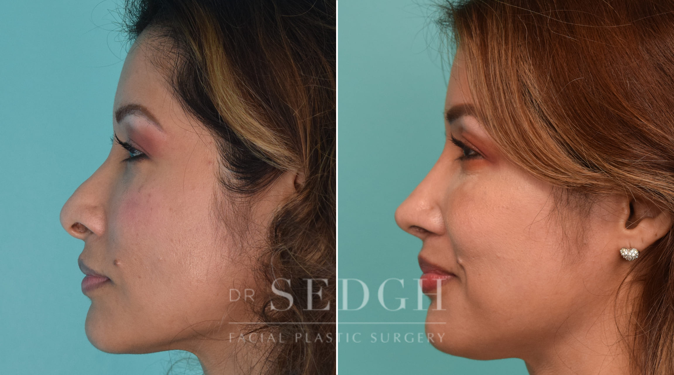 patient before and after revision rhinoplasty procedure