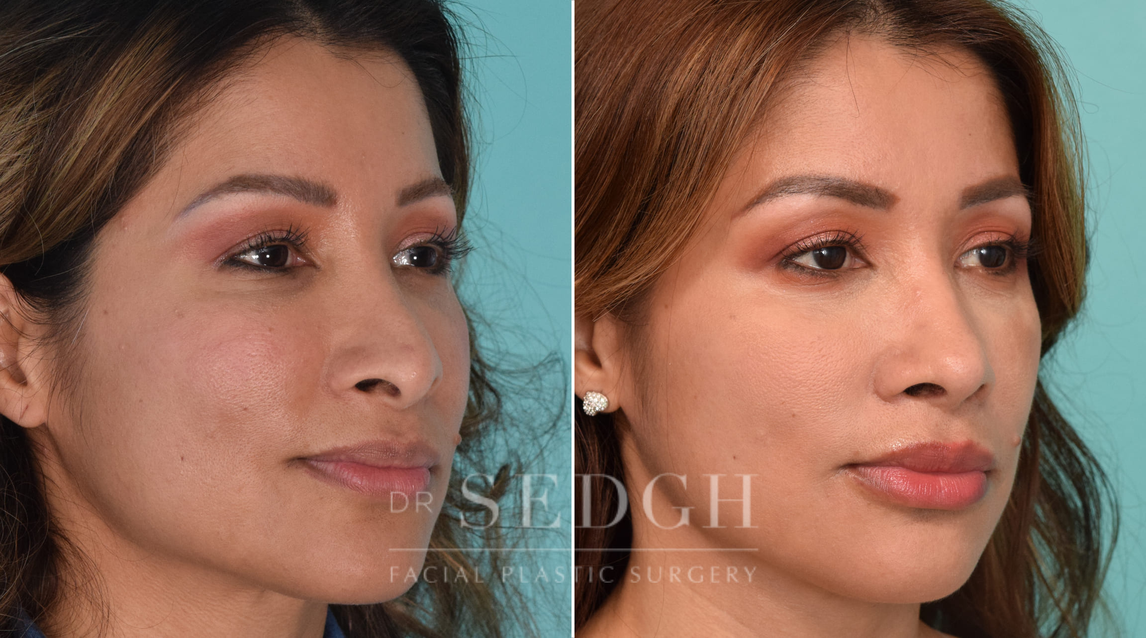 patient before and after revision rhinoplasty procedure