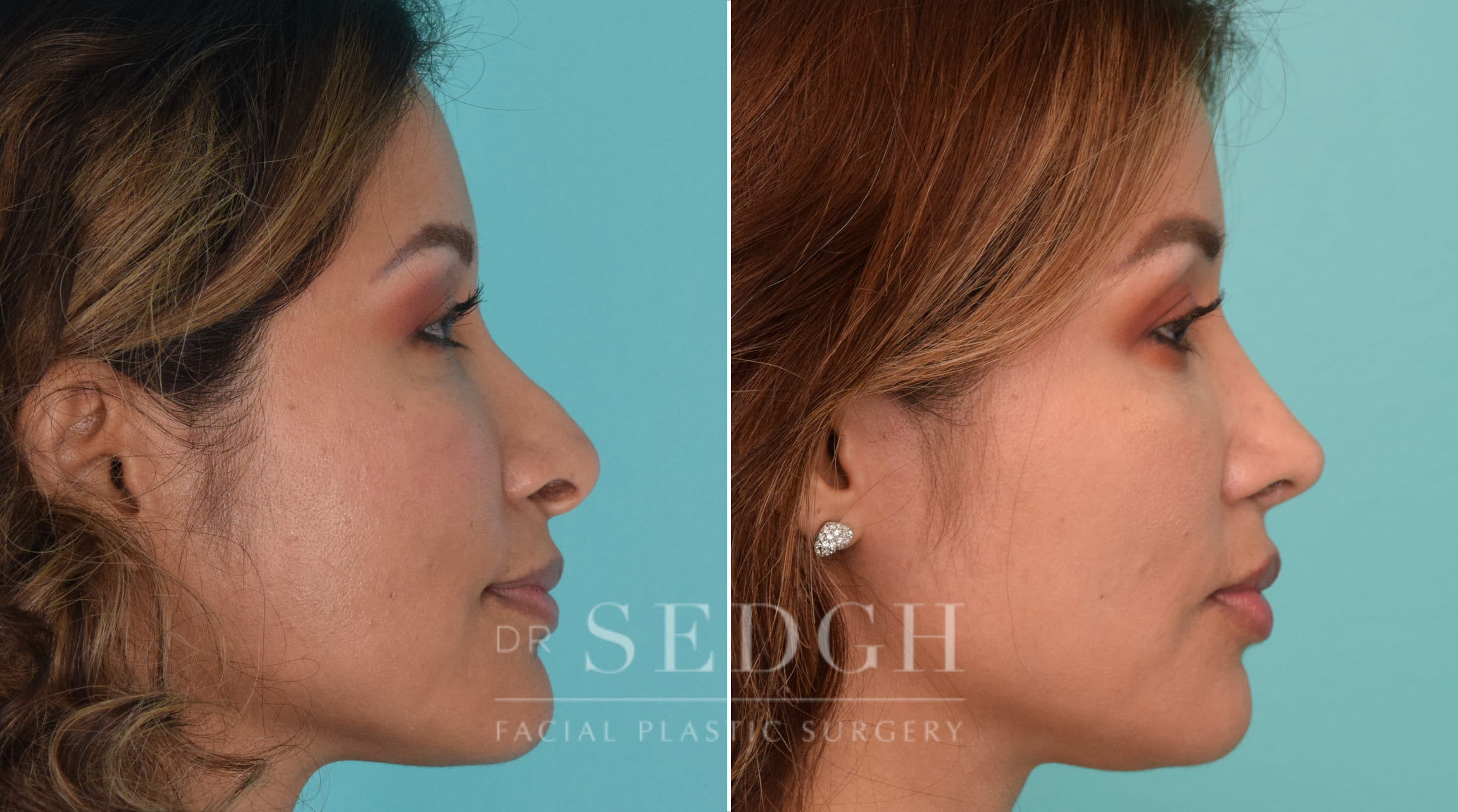 patient before and after revision rhinoplasty procedure