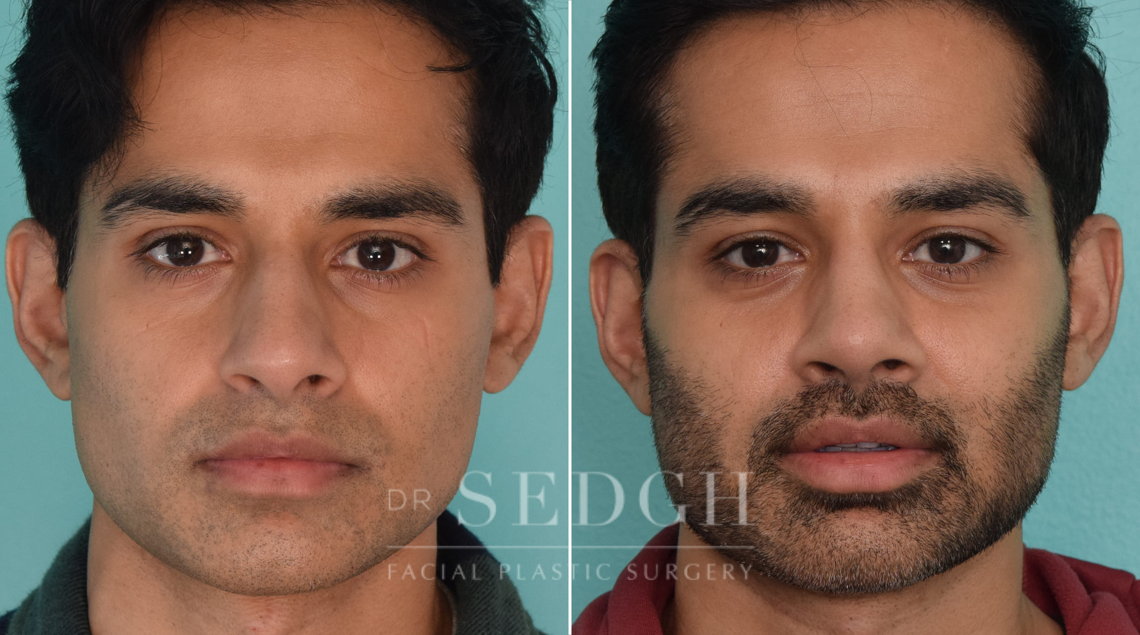 male patient before and after rhinoplasty procedure | Sedgh