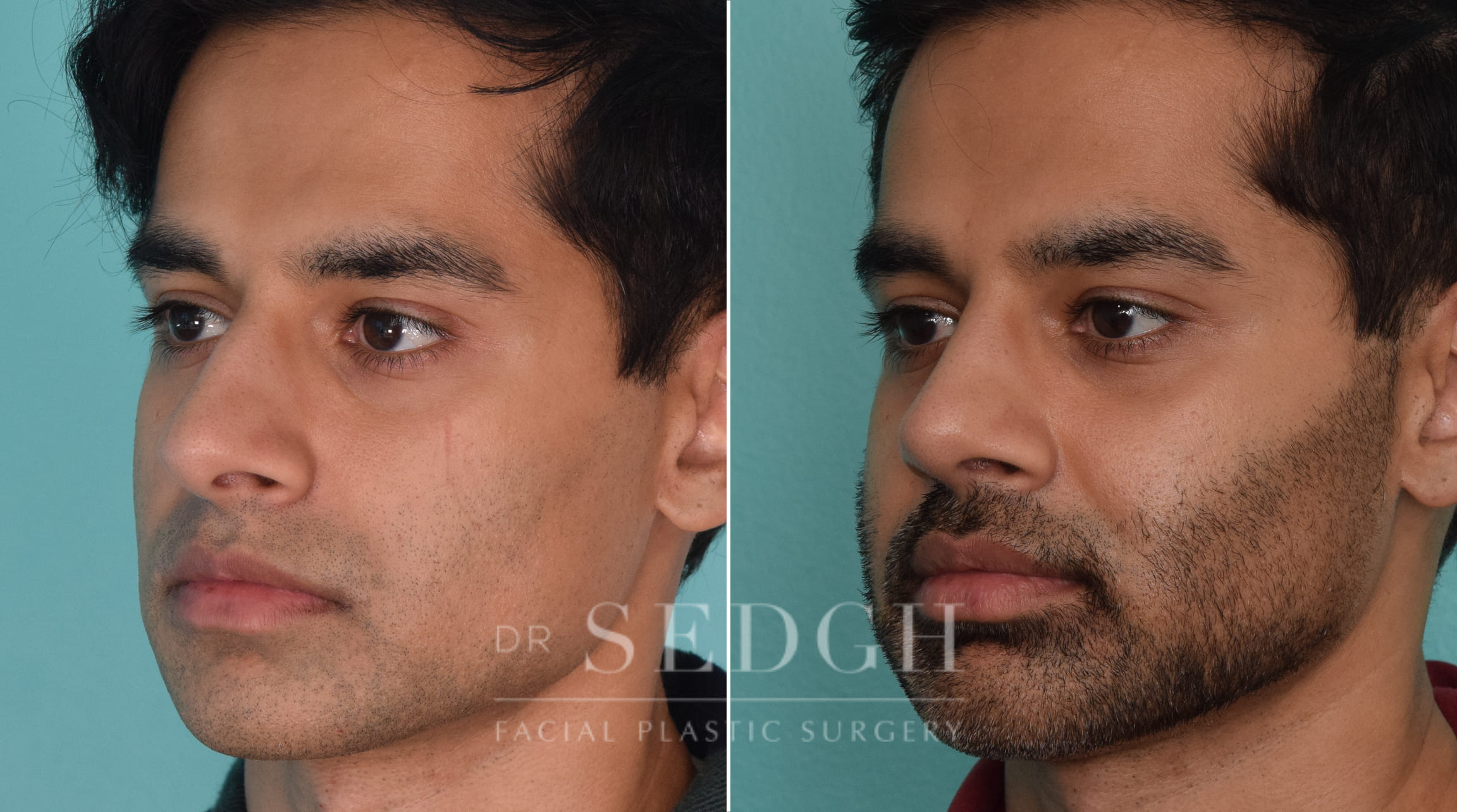 male patient before and after rhinoplasty procedure | Sedgh