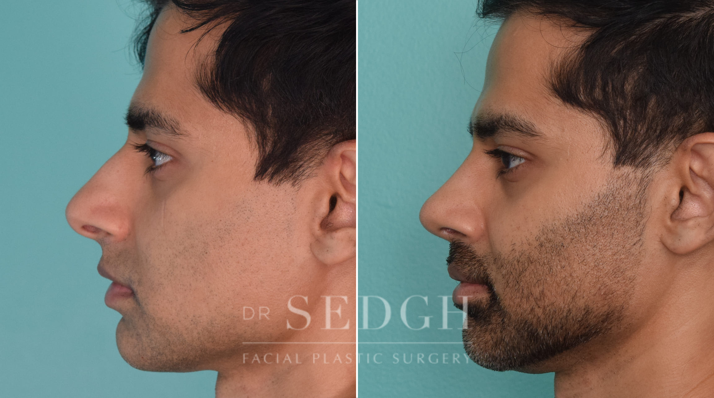 male patient before and after rhinoplasty procedure | Sedgh