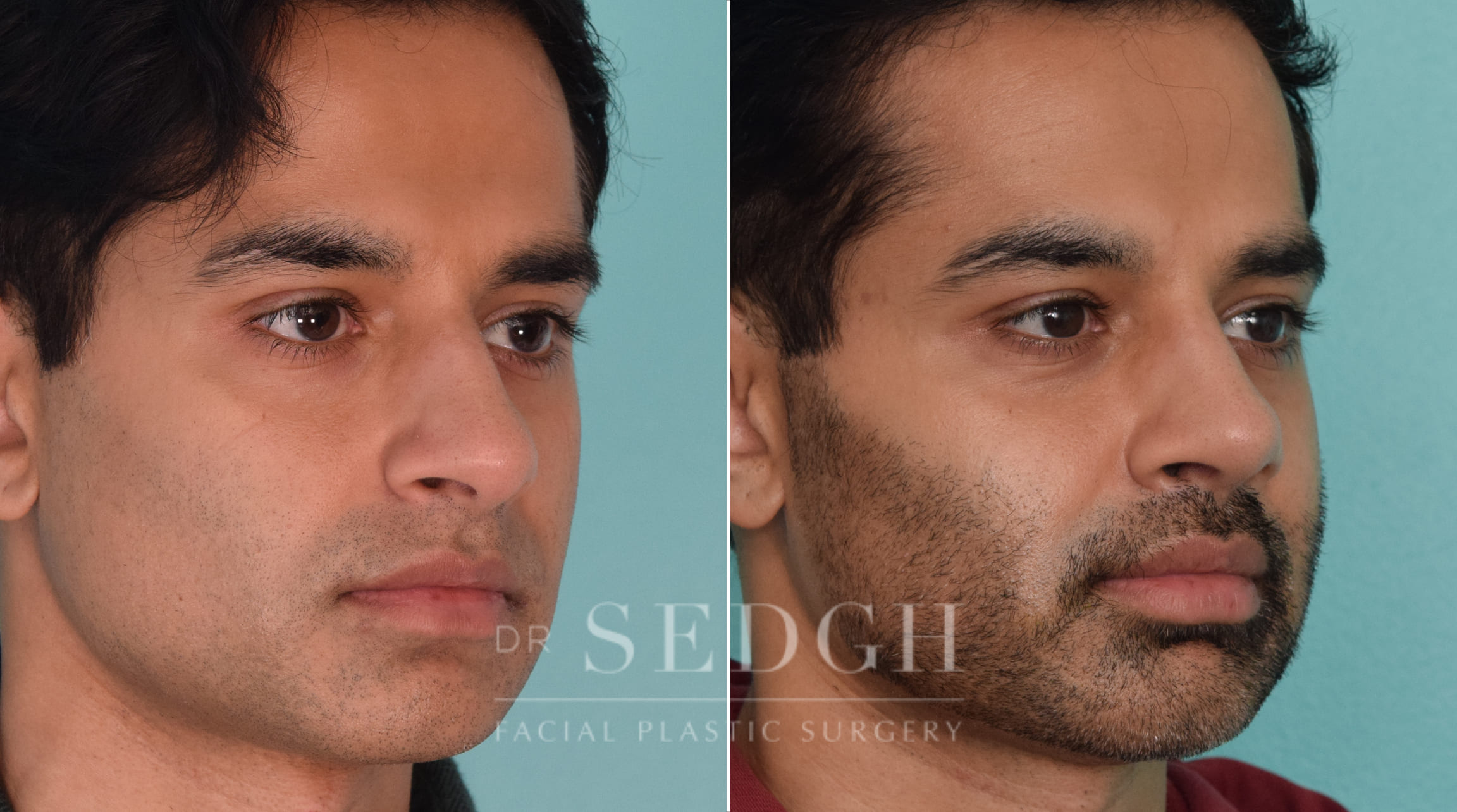 male patient before and after rhinoplasty procedure | Sedgh