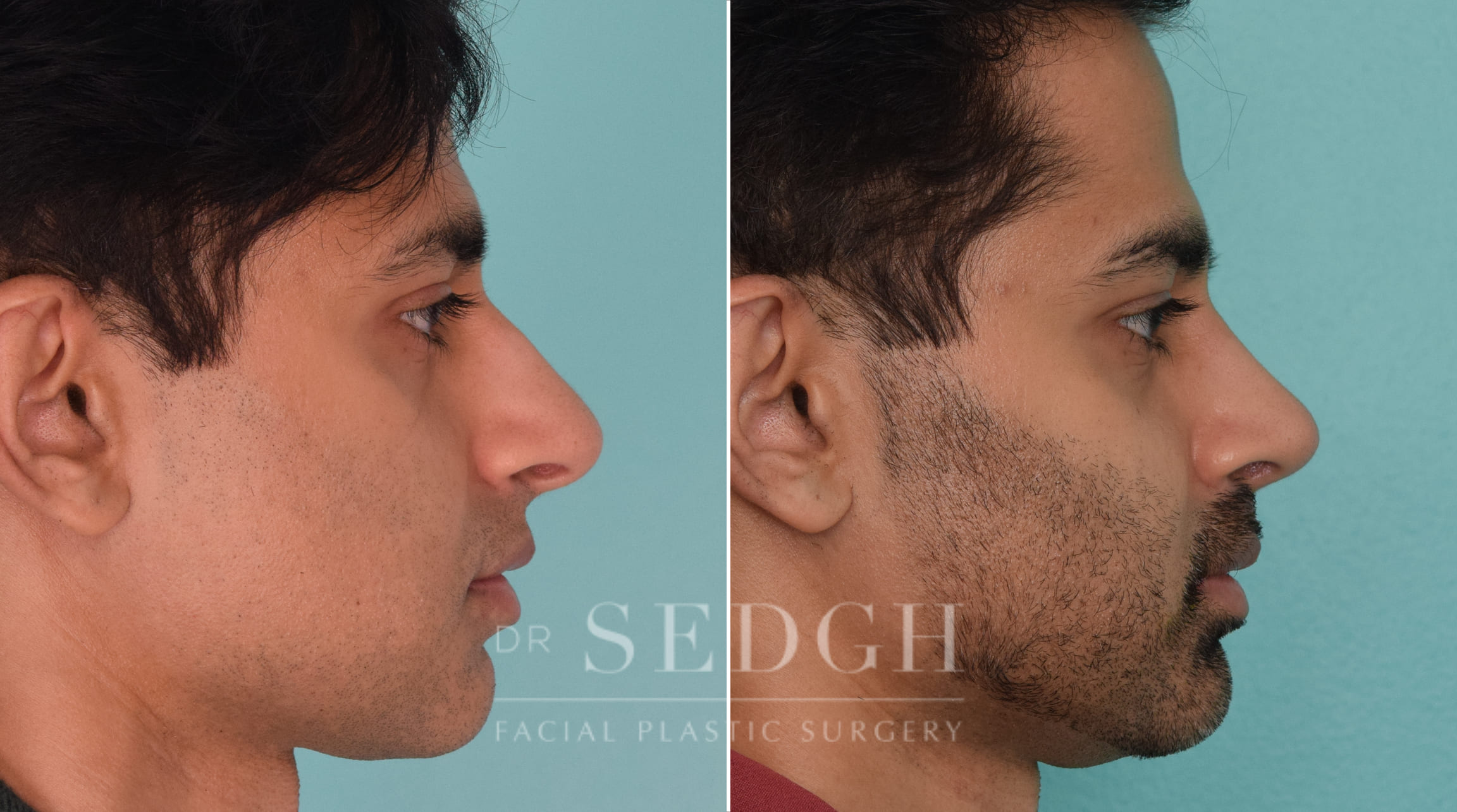 male patient before and after rhinoplasty procedure | Sedgh