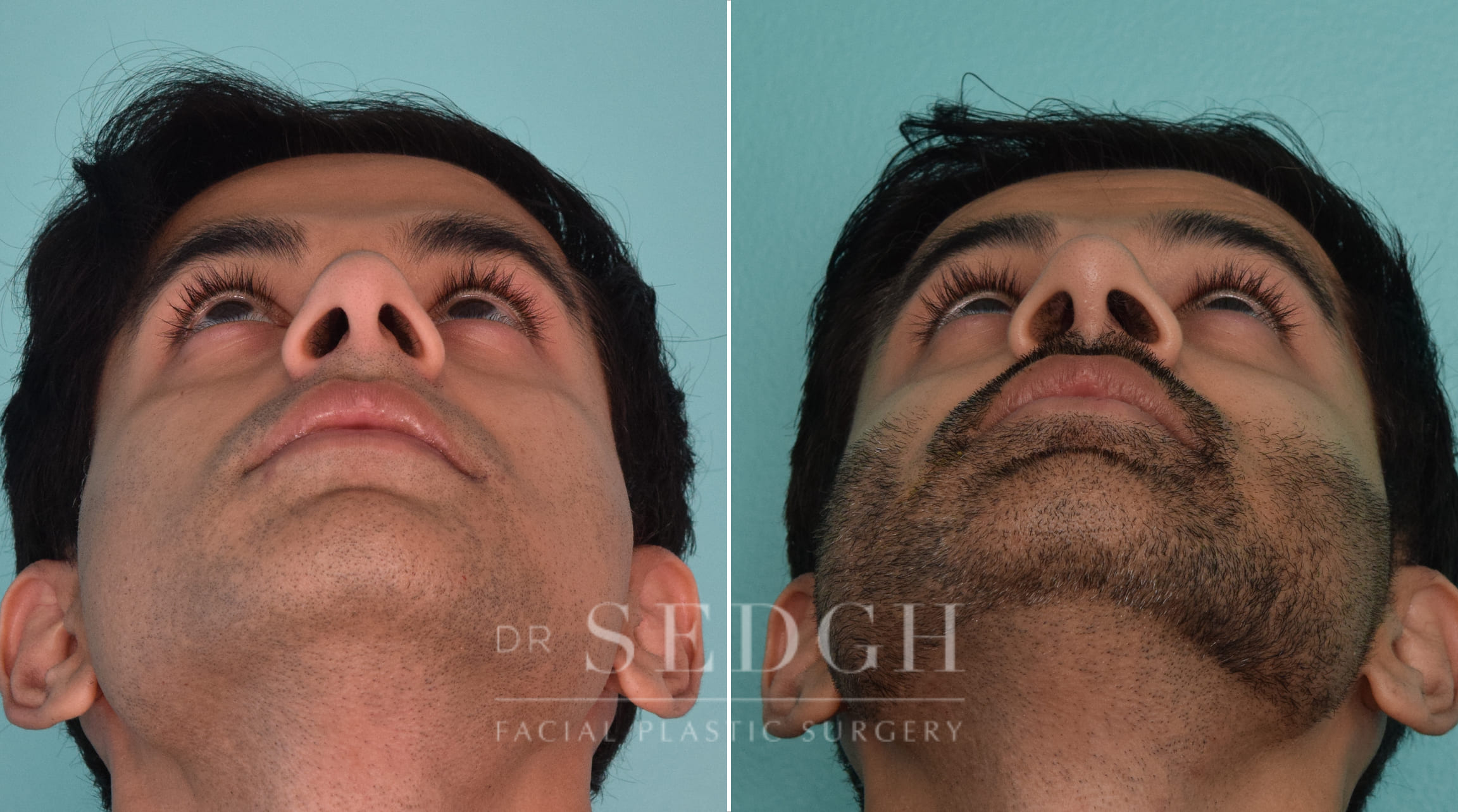 male patient before and after rhinoplasty procedure | Sedgh