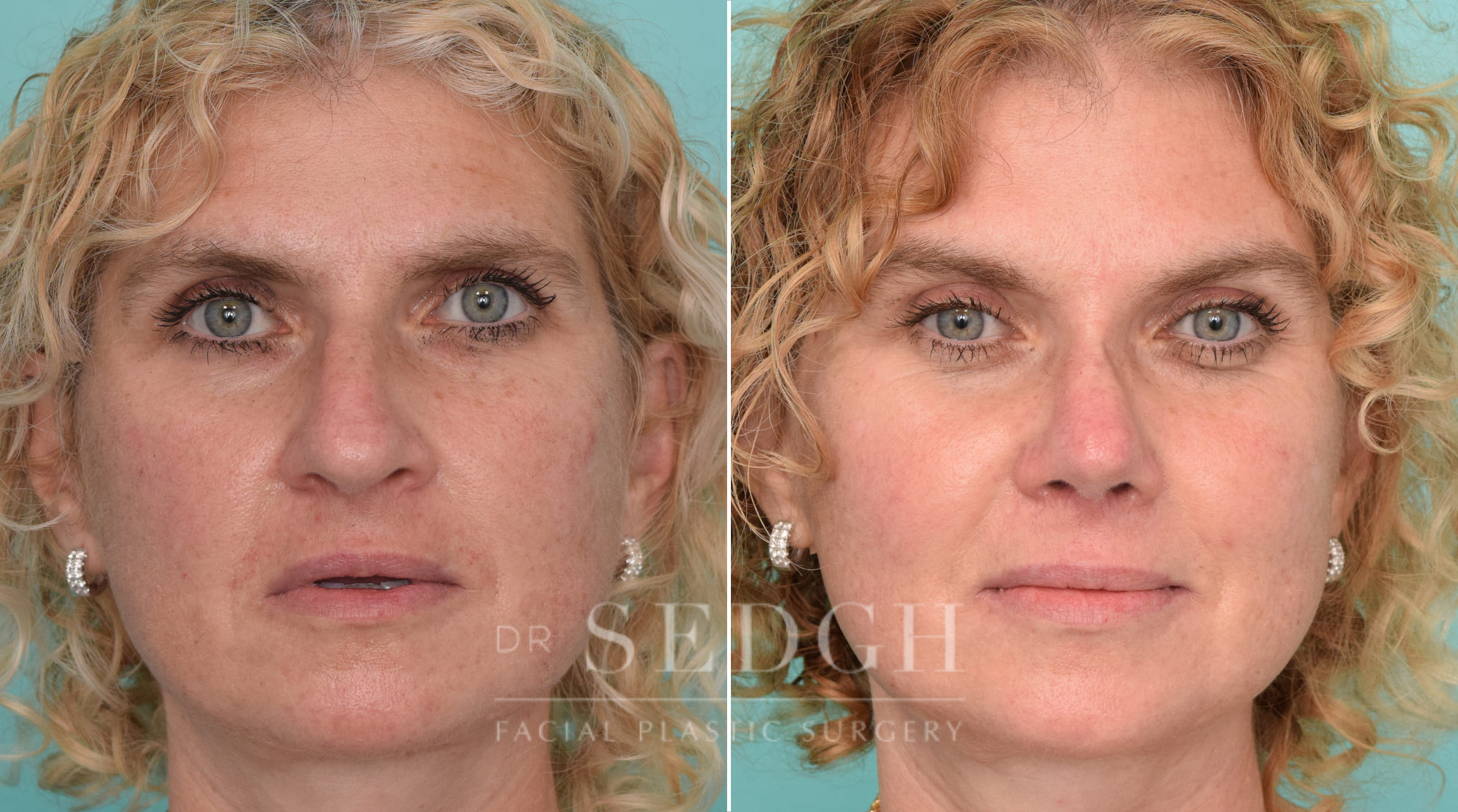 Female Patient Before and After Brow Lift | Sedgh