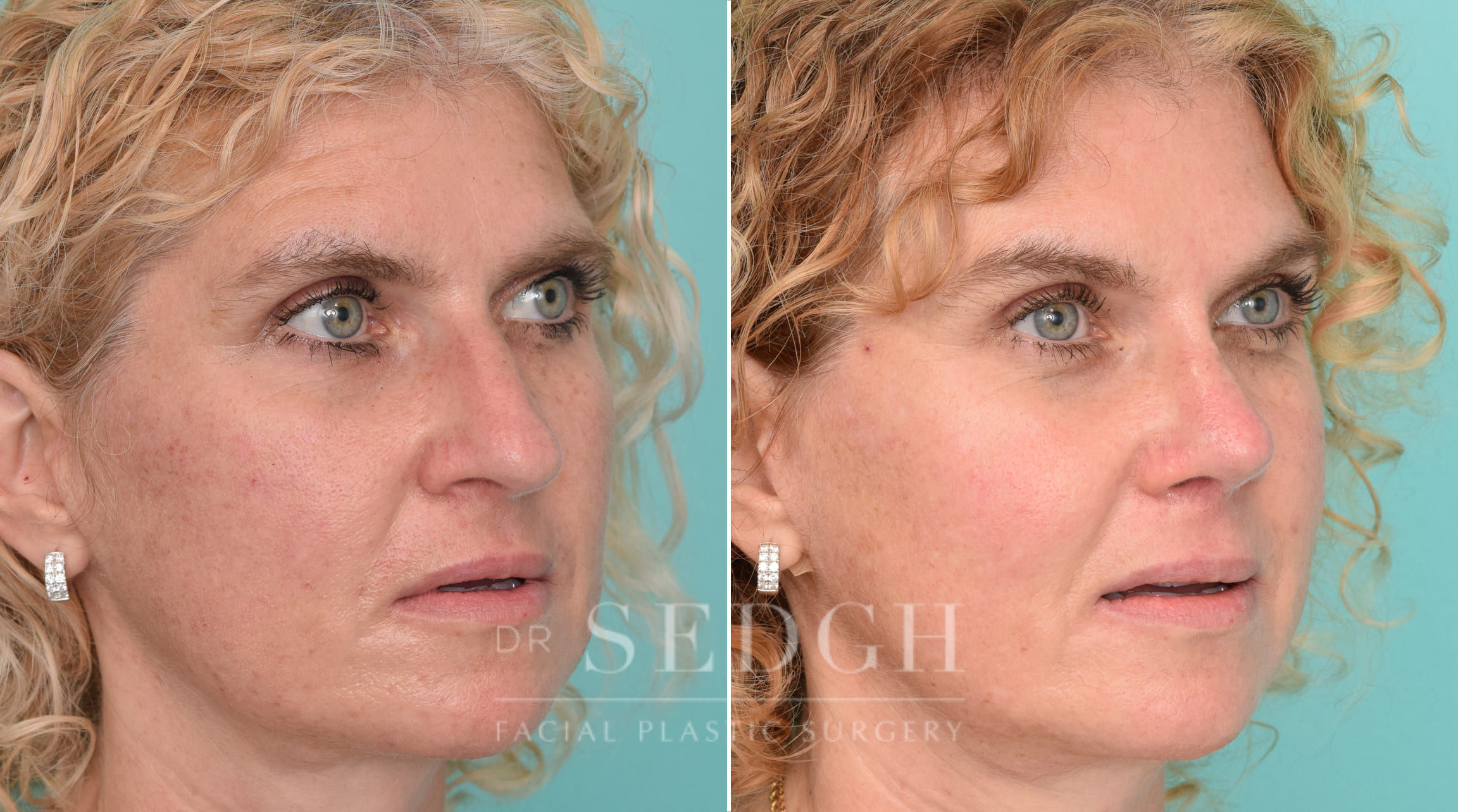 Female Patient Before and After Brow Lift | Sedgh