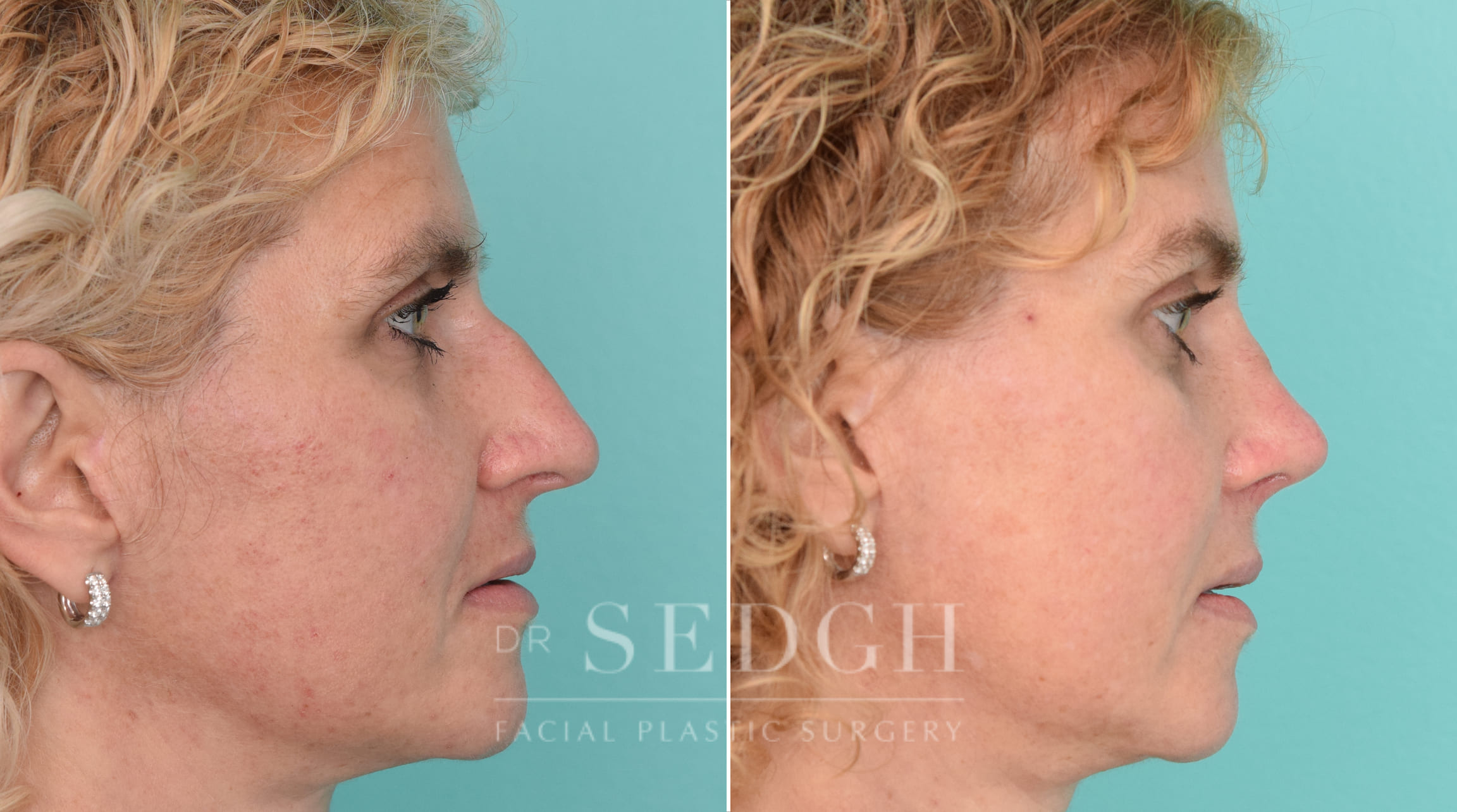 Female Patient Before and After Brow Lift | Sedgh