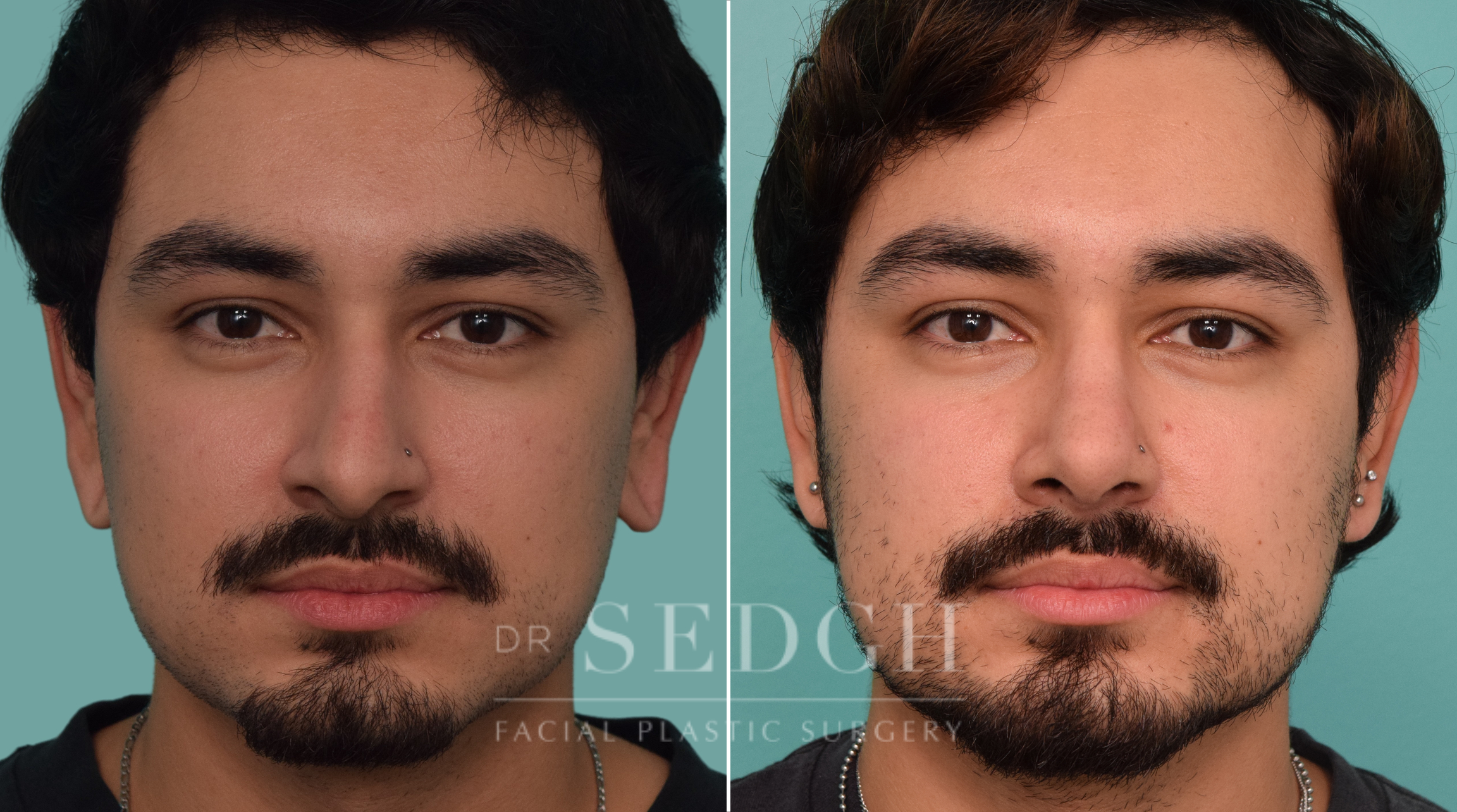 male patient before and after rhinoplasty procedure