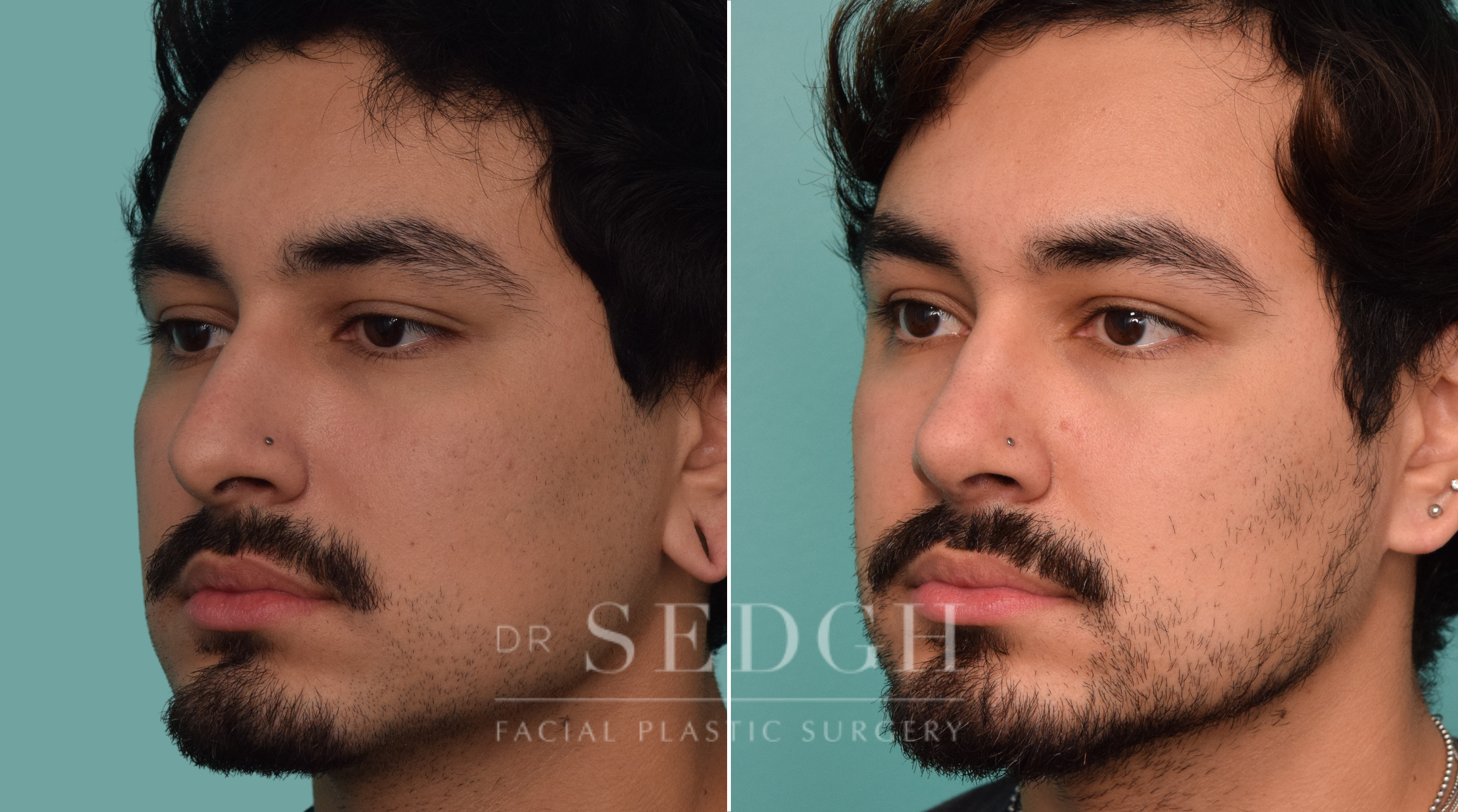 male patient before and after rhinoplasty procedure