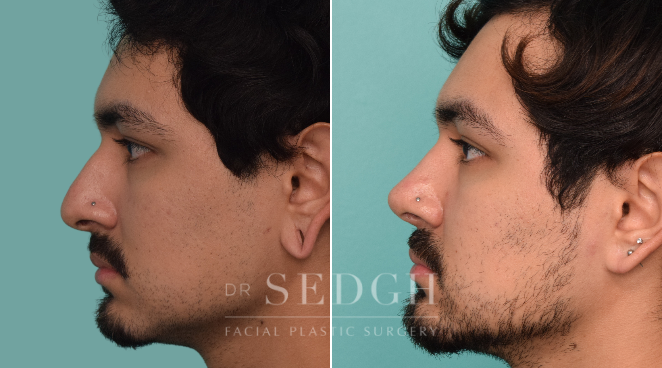 male patient before and after rhinoplasty procedure