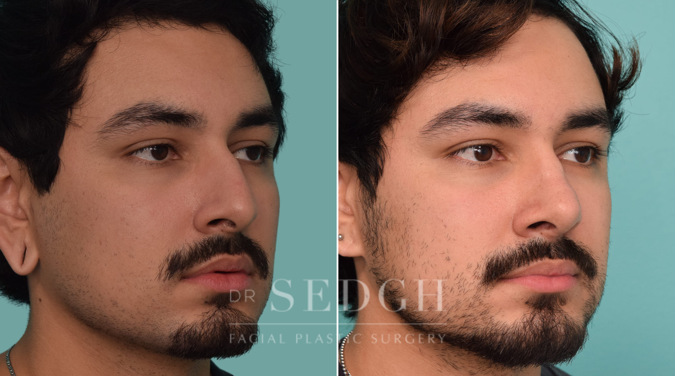 male patient before and after rhinoplasty procedure